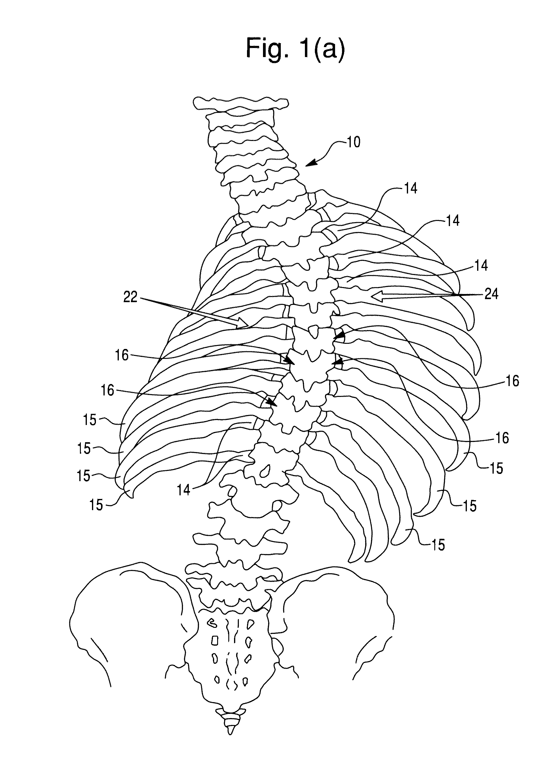 Segmental orthopedic device for spinal elongation and for treatment of scoliosis