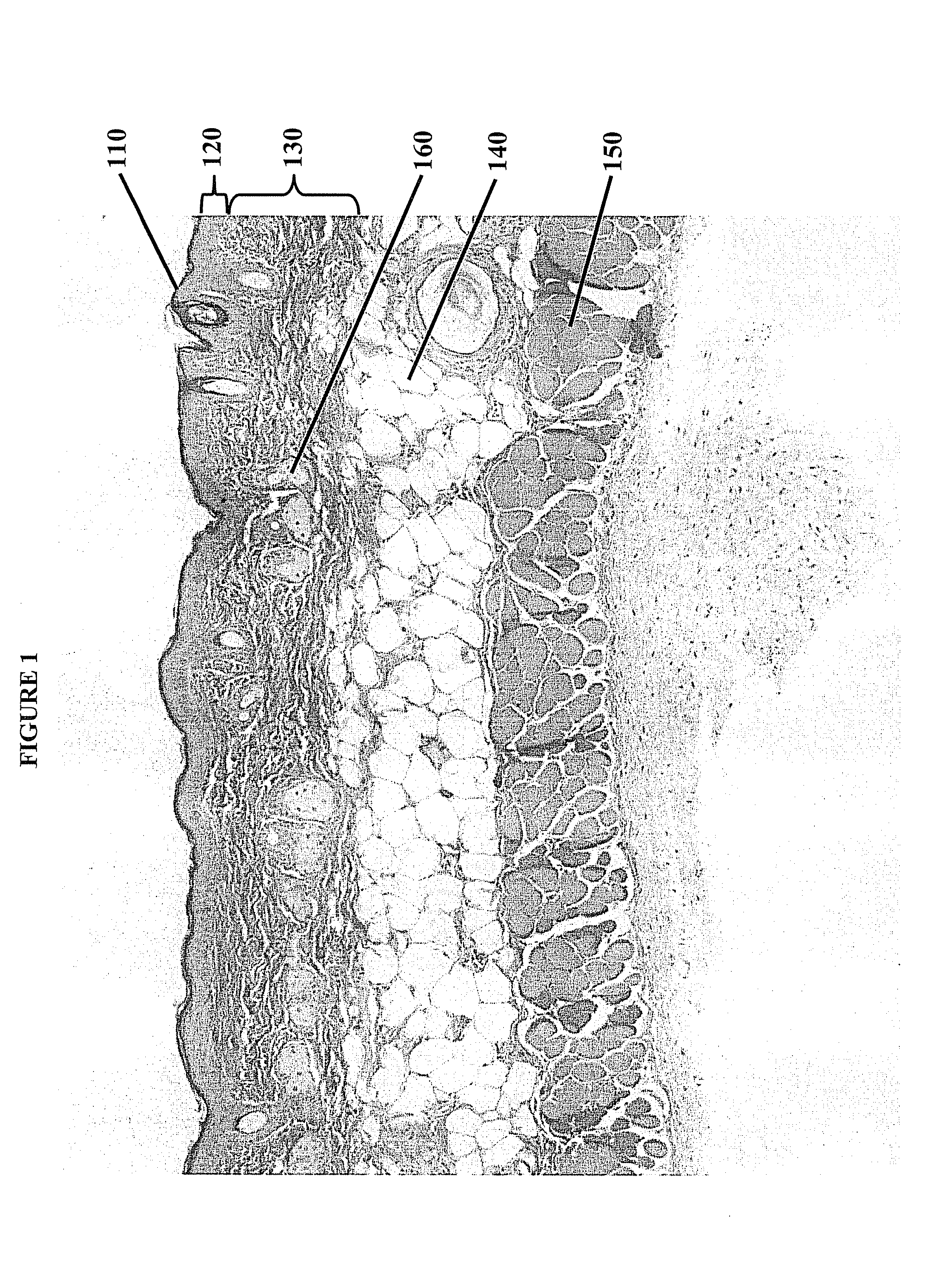 Reducing fibrosis using matrix metalloproteinase inhibitors