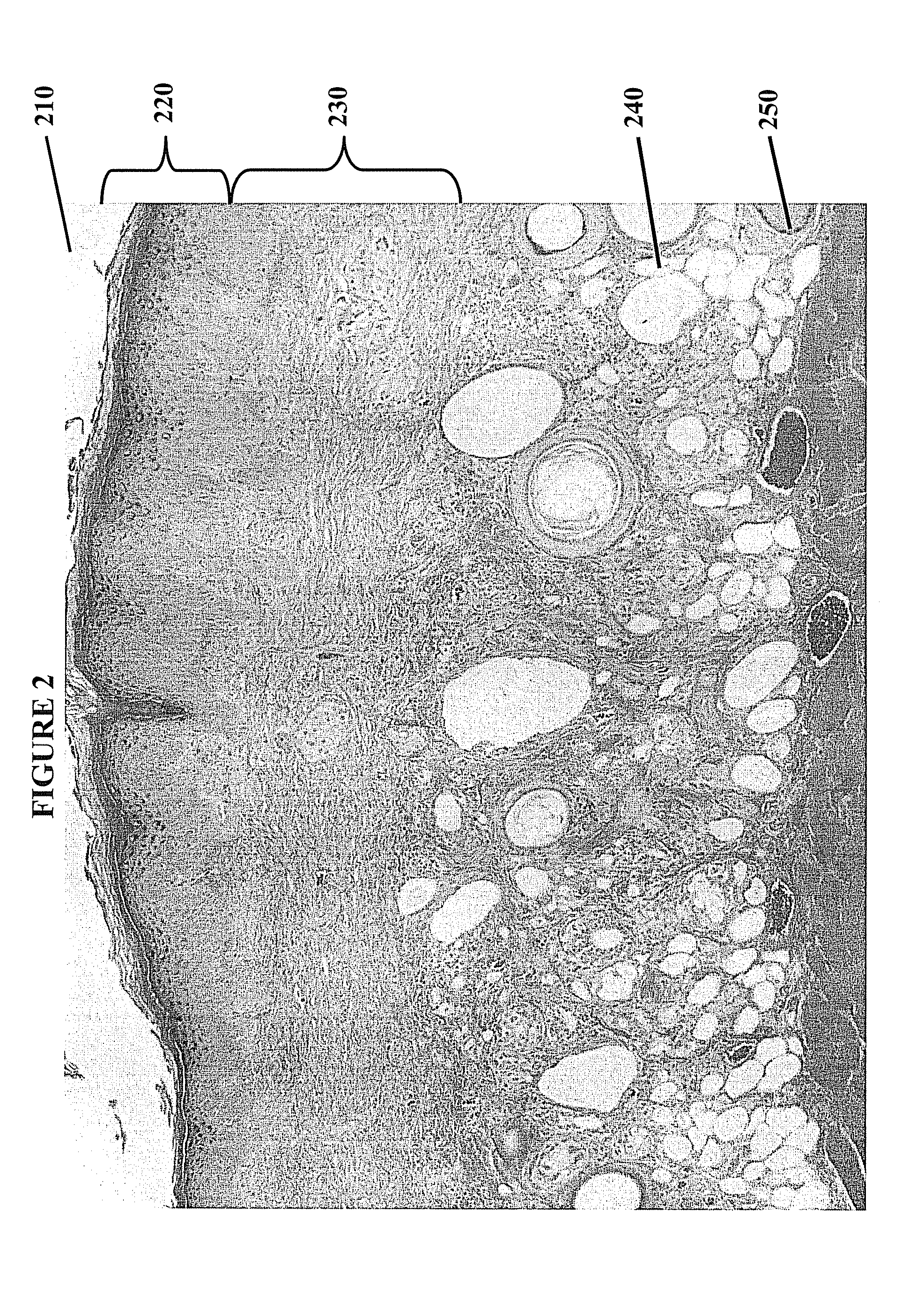 Reducing fibrosis using matrix metalloproteinase inhibitors