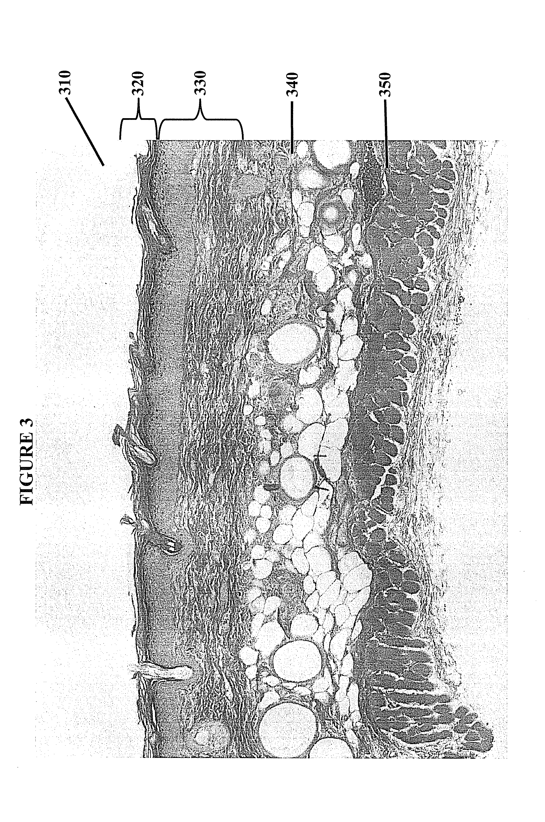 Reducing fibrosis using matrix metalloproteinase inhibitors