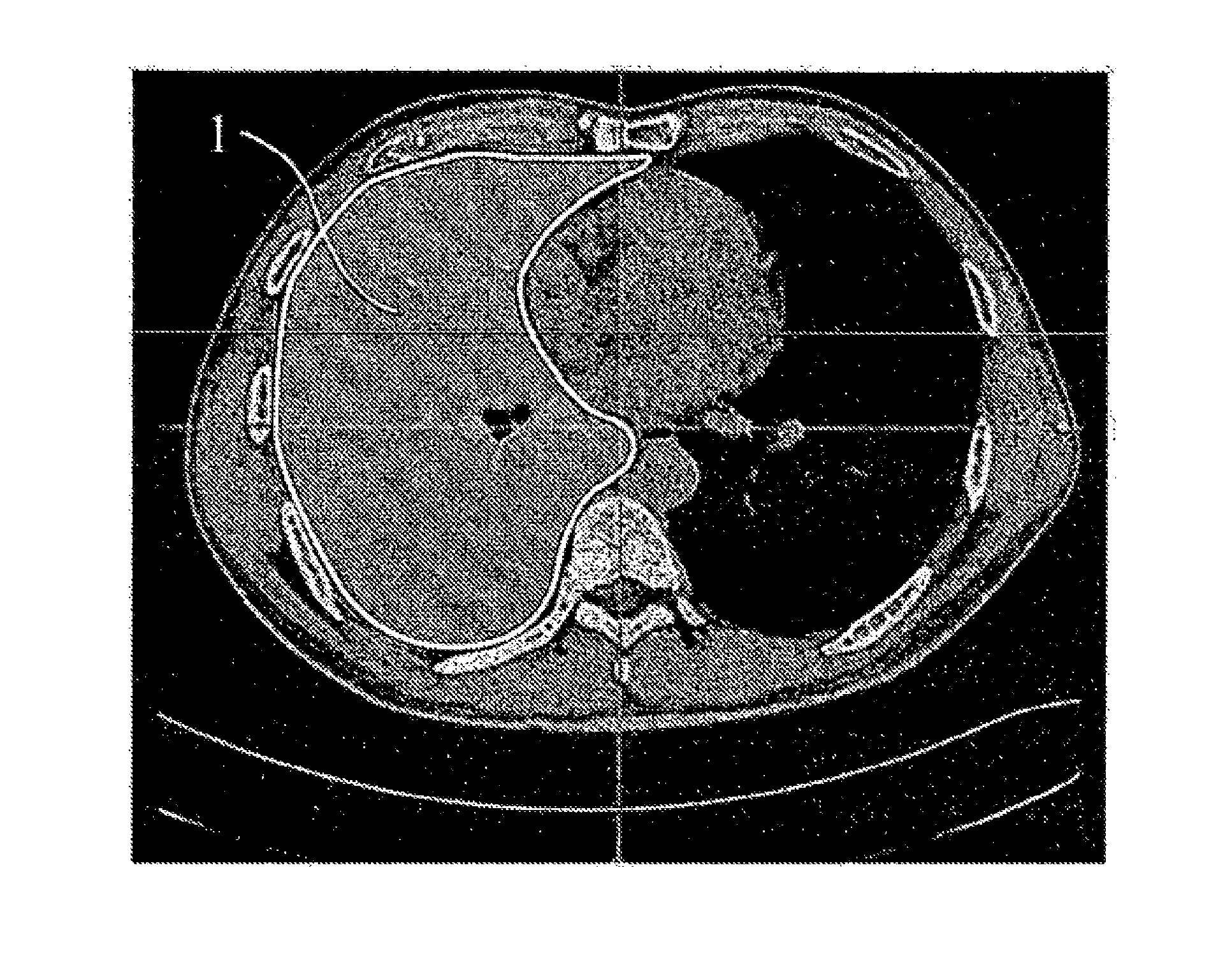 Method for distinguishing pulmonary artery and pulmonary vein, and method for quantifying blood vessels using same