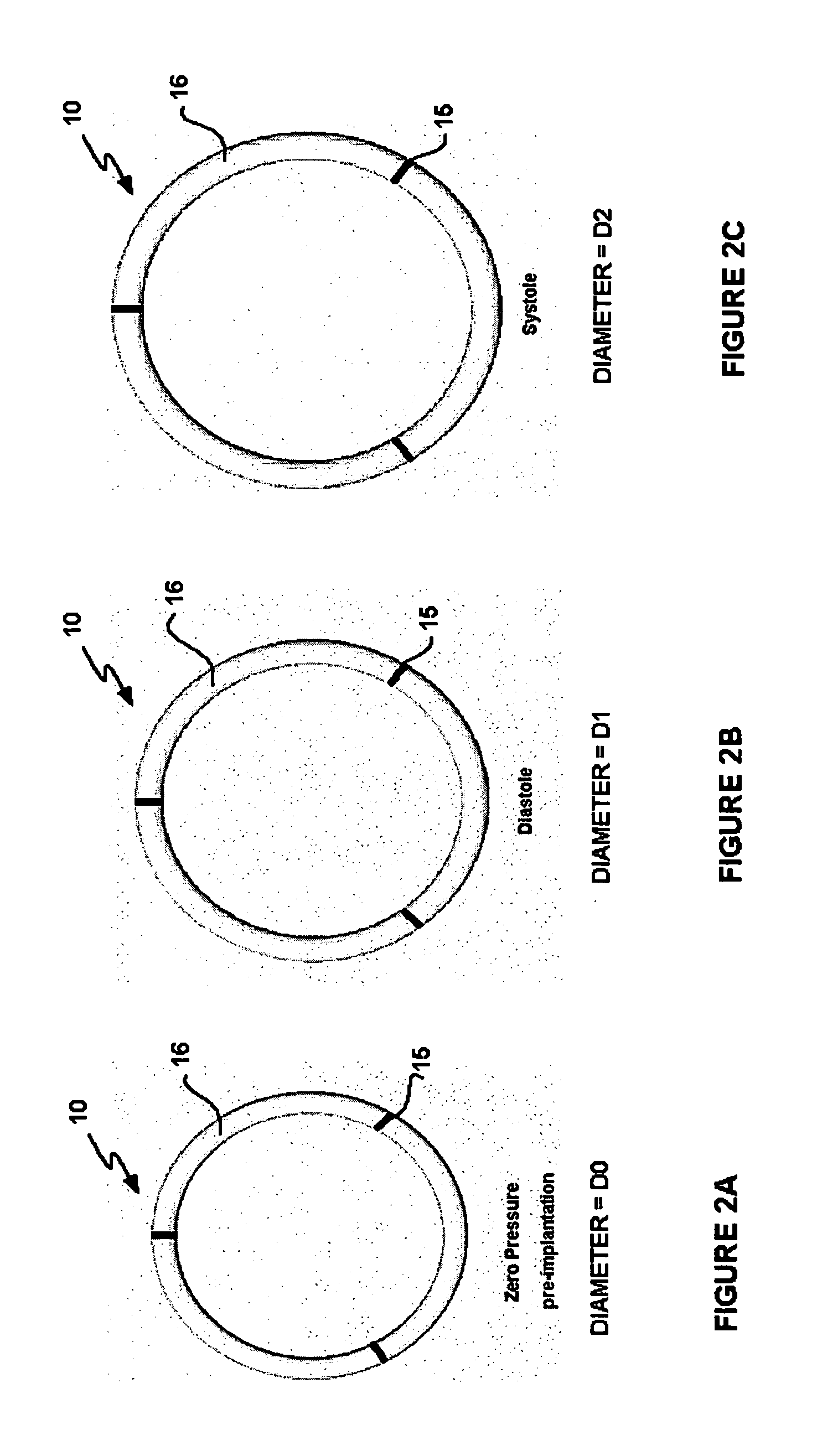 Expandable annuloplasty ring and associated ring holder