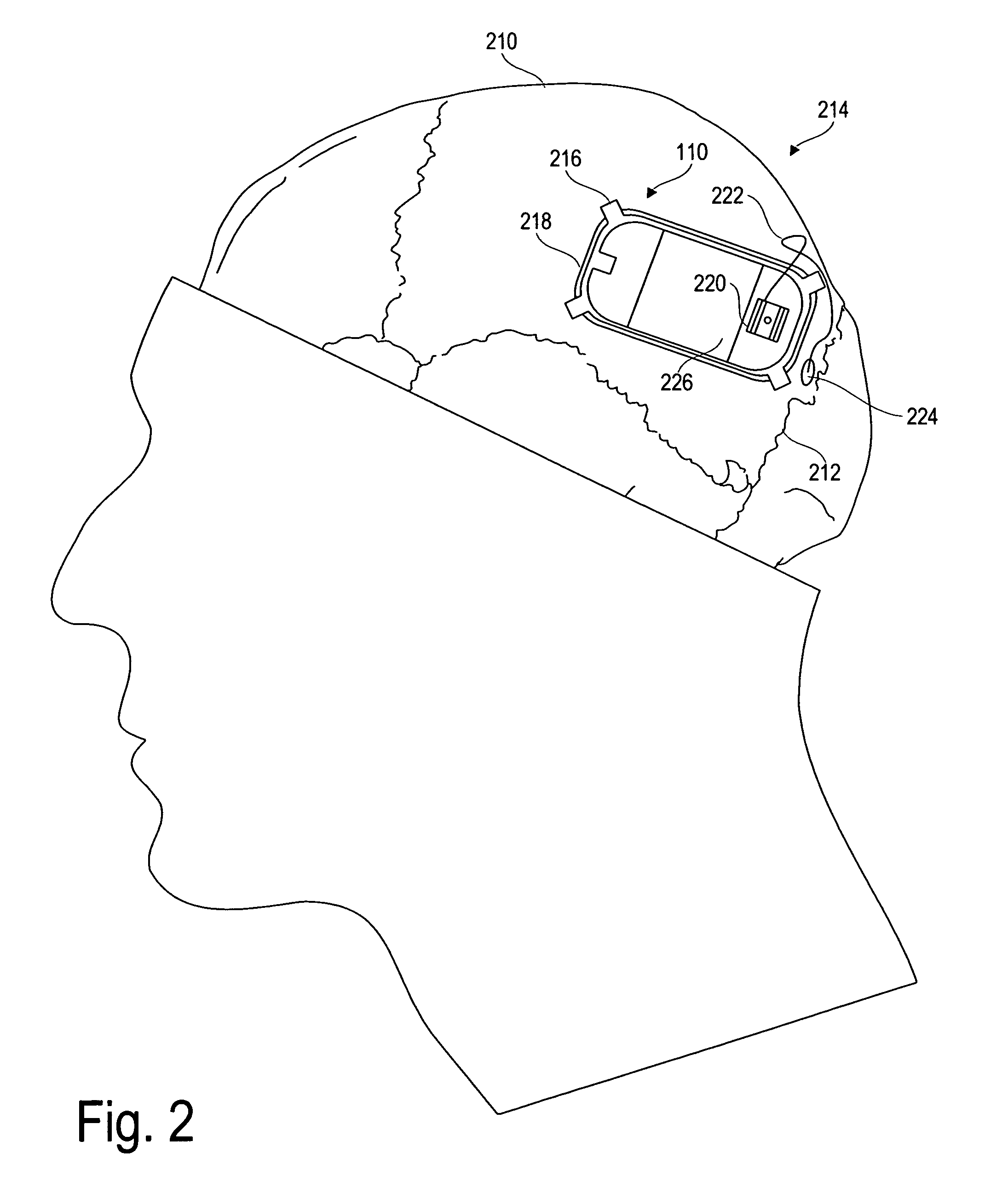 Seizure therapy and suppression using an implantable device