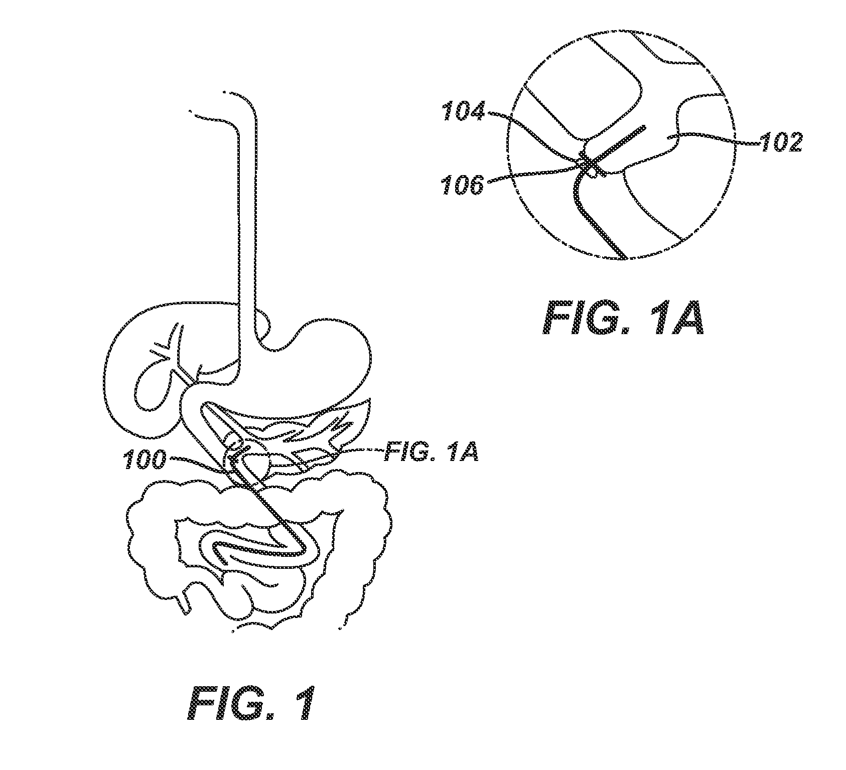 Catheter For Deactivating At Least A Portion of the Digestive Enzymes In An Amount Of Bile