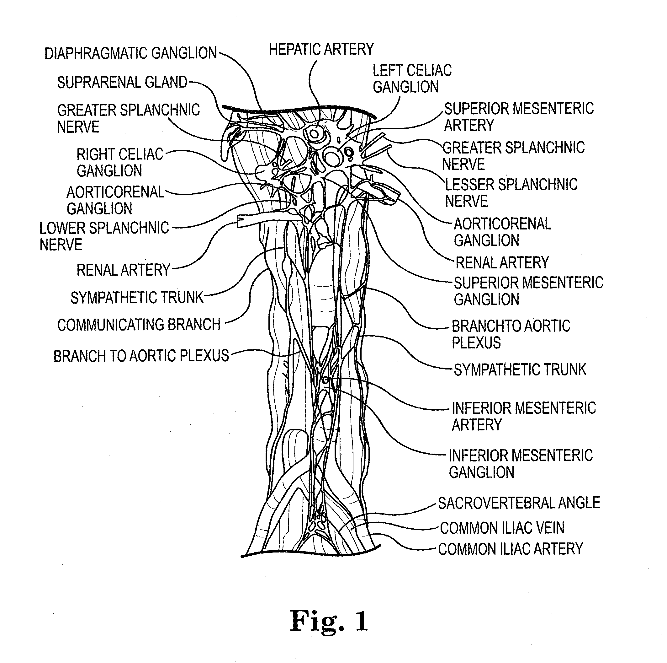 System and method of pre-aortic ganglion ablation