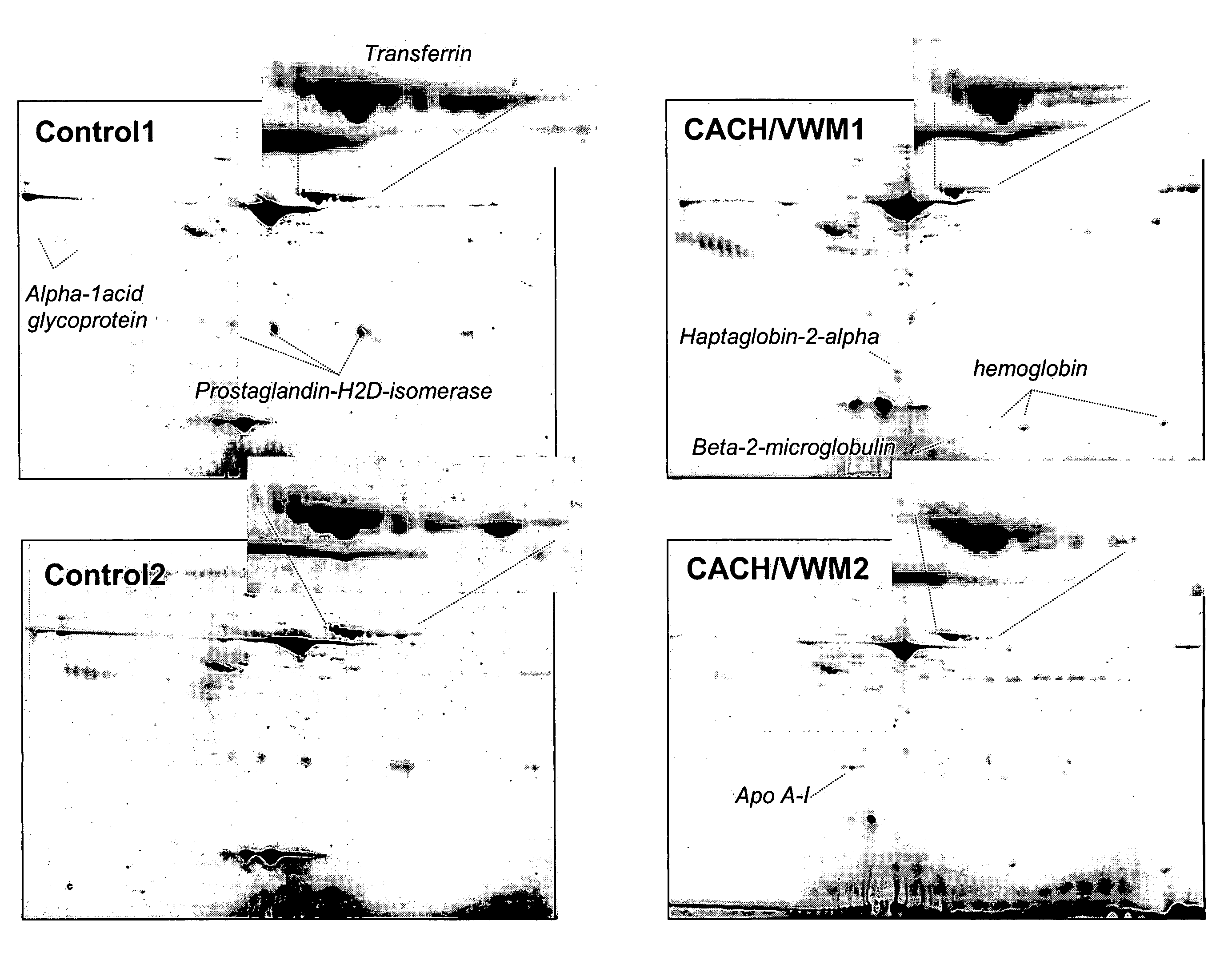 Biochemical marker for diagnosing a leukodystrophy