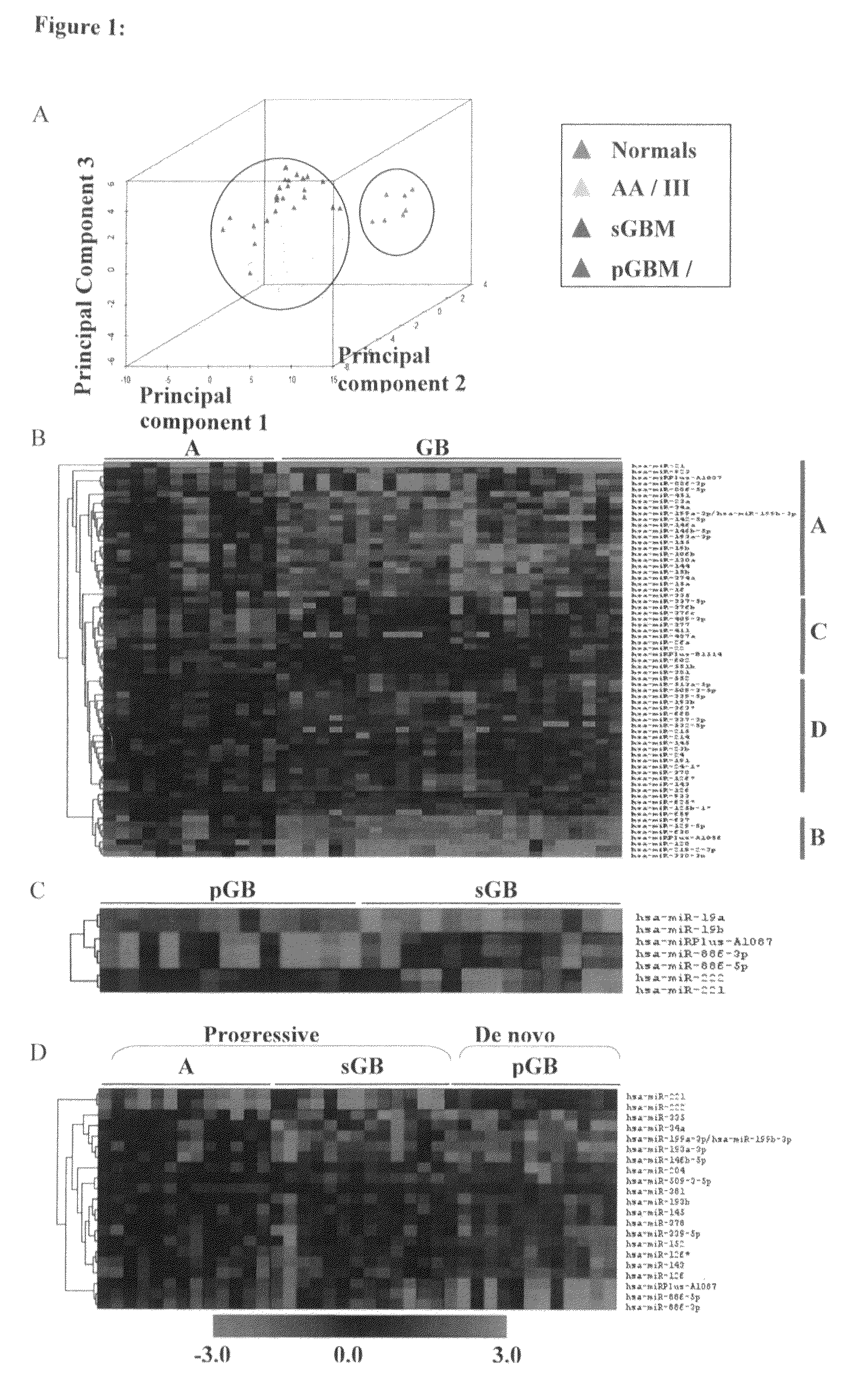 MicroRNAs (miRNA) as biomarkers for diagnosing different grades of gliomas and pathways of glioma progression