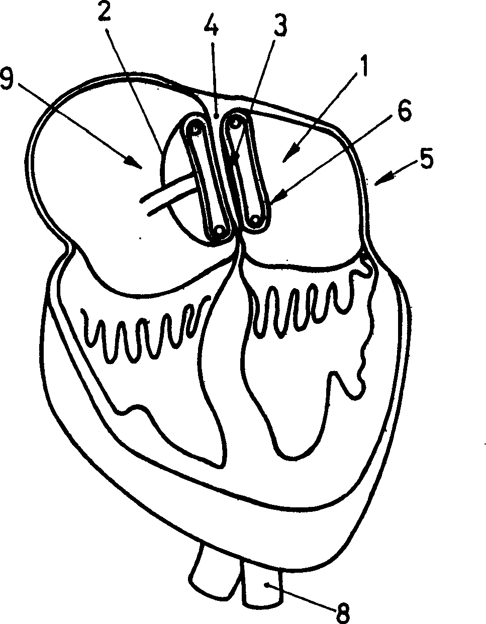 A device for plugging an opening such as in a wall of a hollow or tubular organ