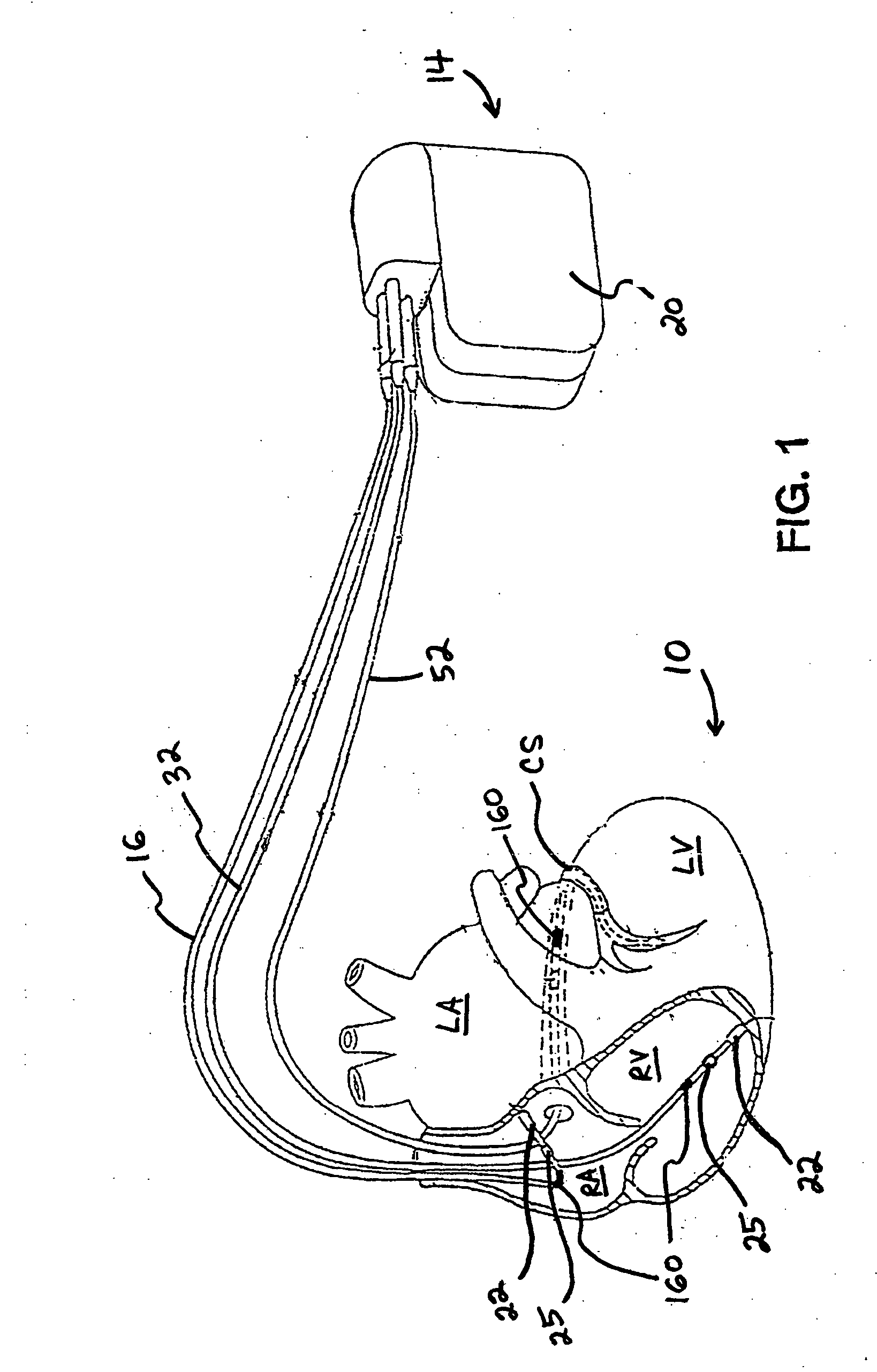 Method and system for controlling pulmonary capillary pressure