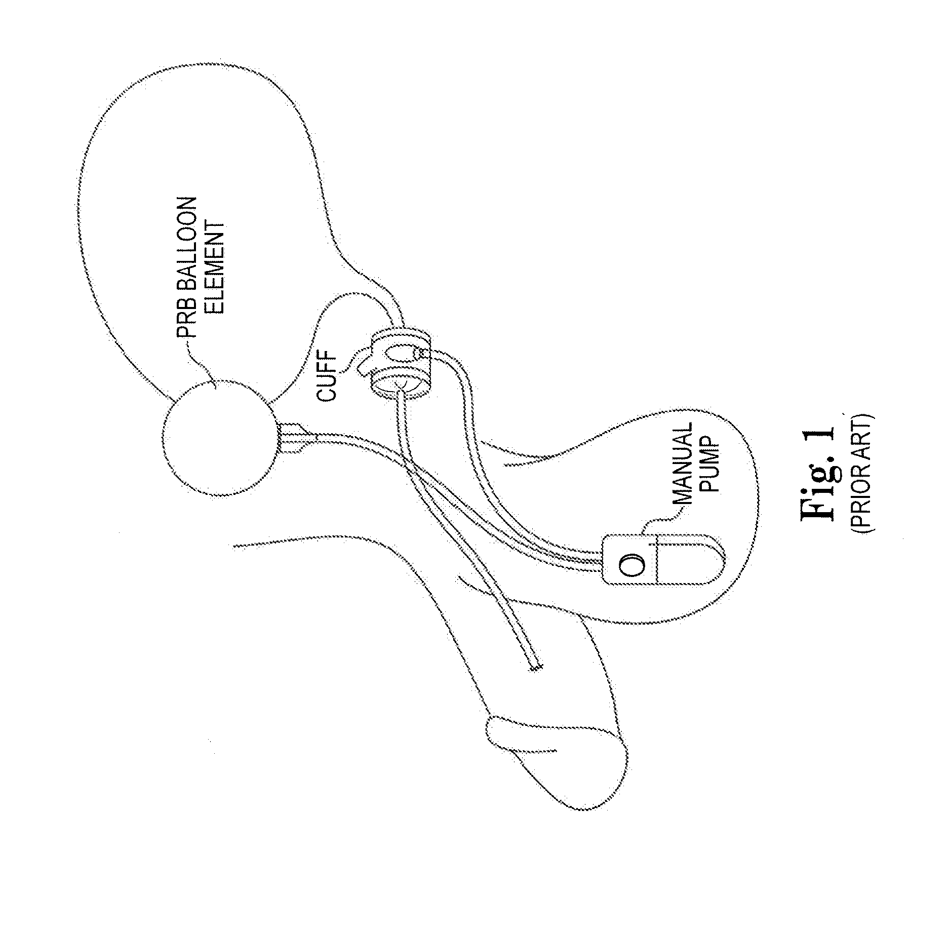 Artificial Sphincter System and Method