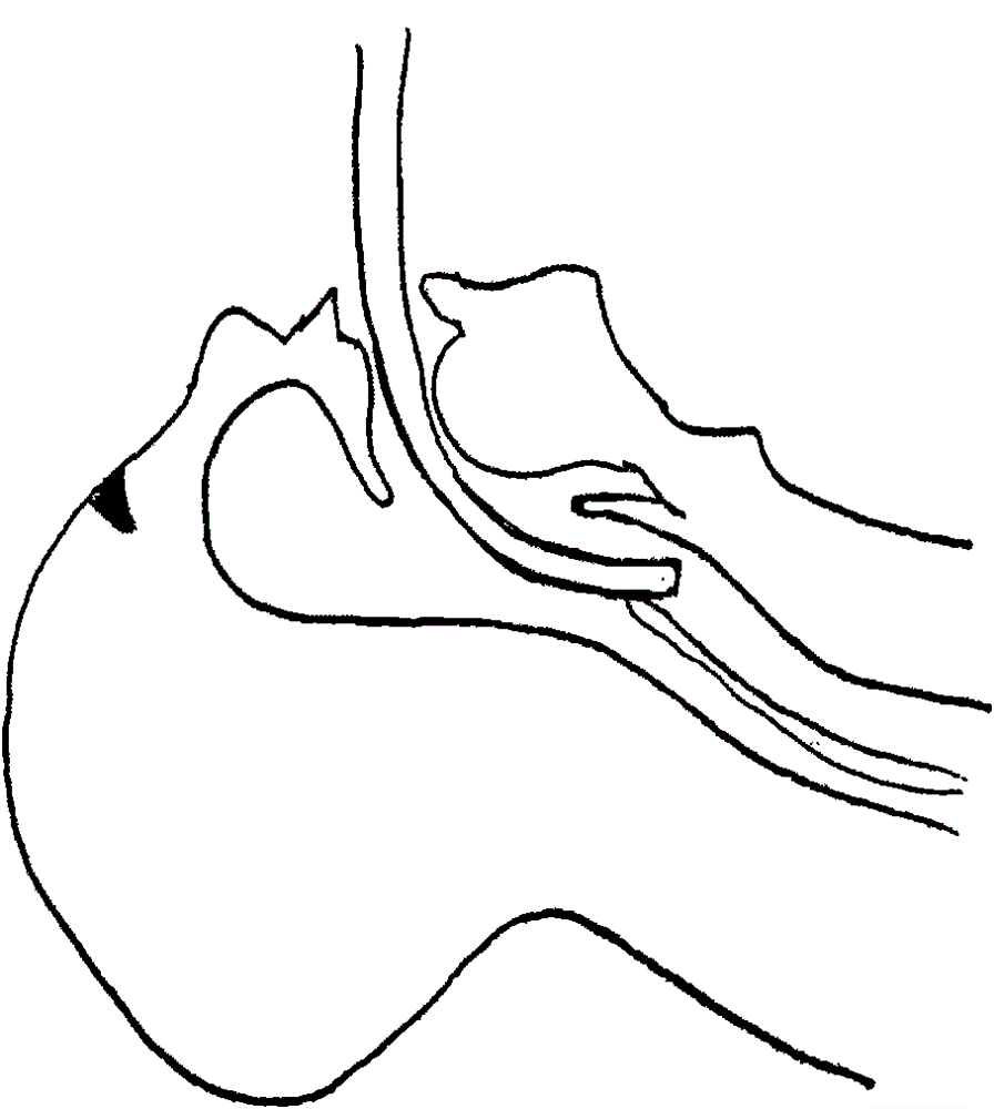 A kind of endotracheal intubation guide