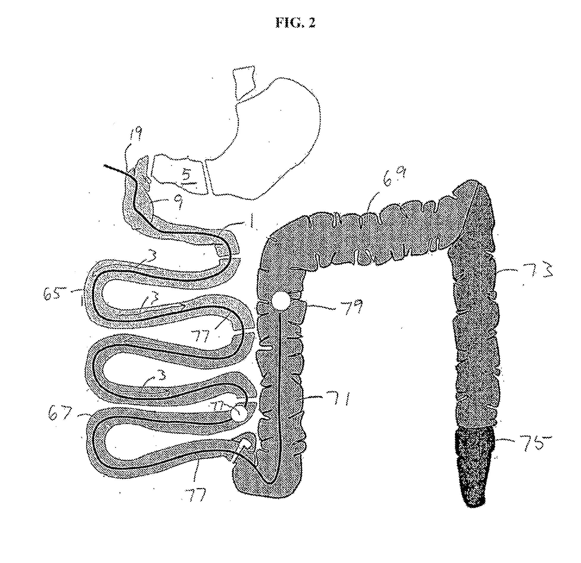 Methods and Apparatus for Treating Obesity and Diabetes