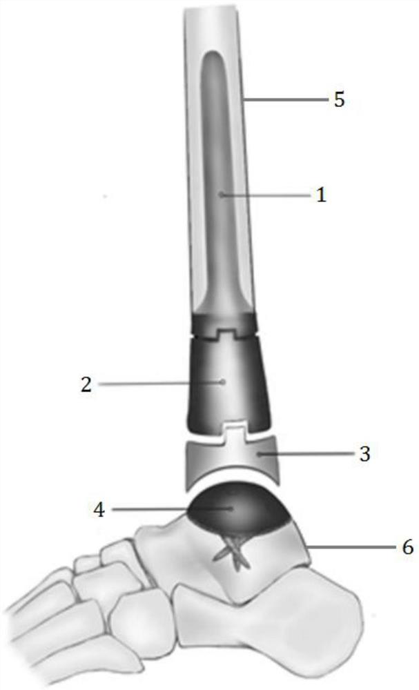 Talus fusion surface type artificial ankle joint prosthesis