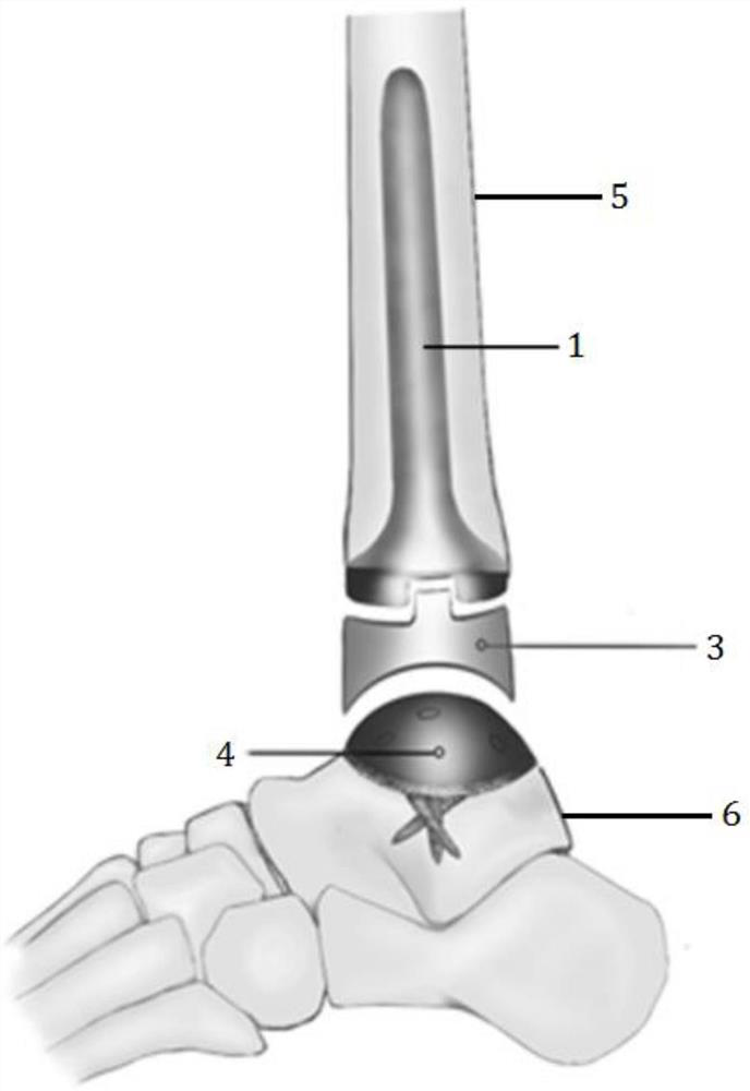 Talus fusion surface type artificial ankle joint prosthesis