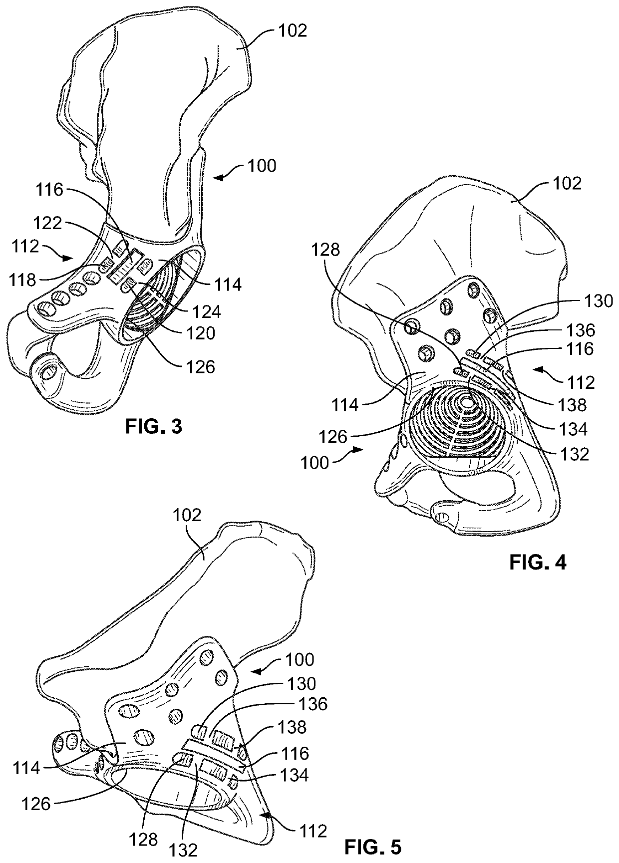 Systems and methods for attaching soft tissue to an implant