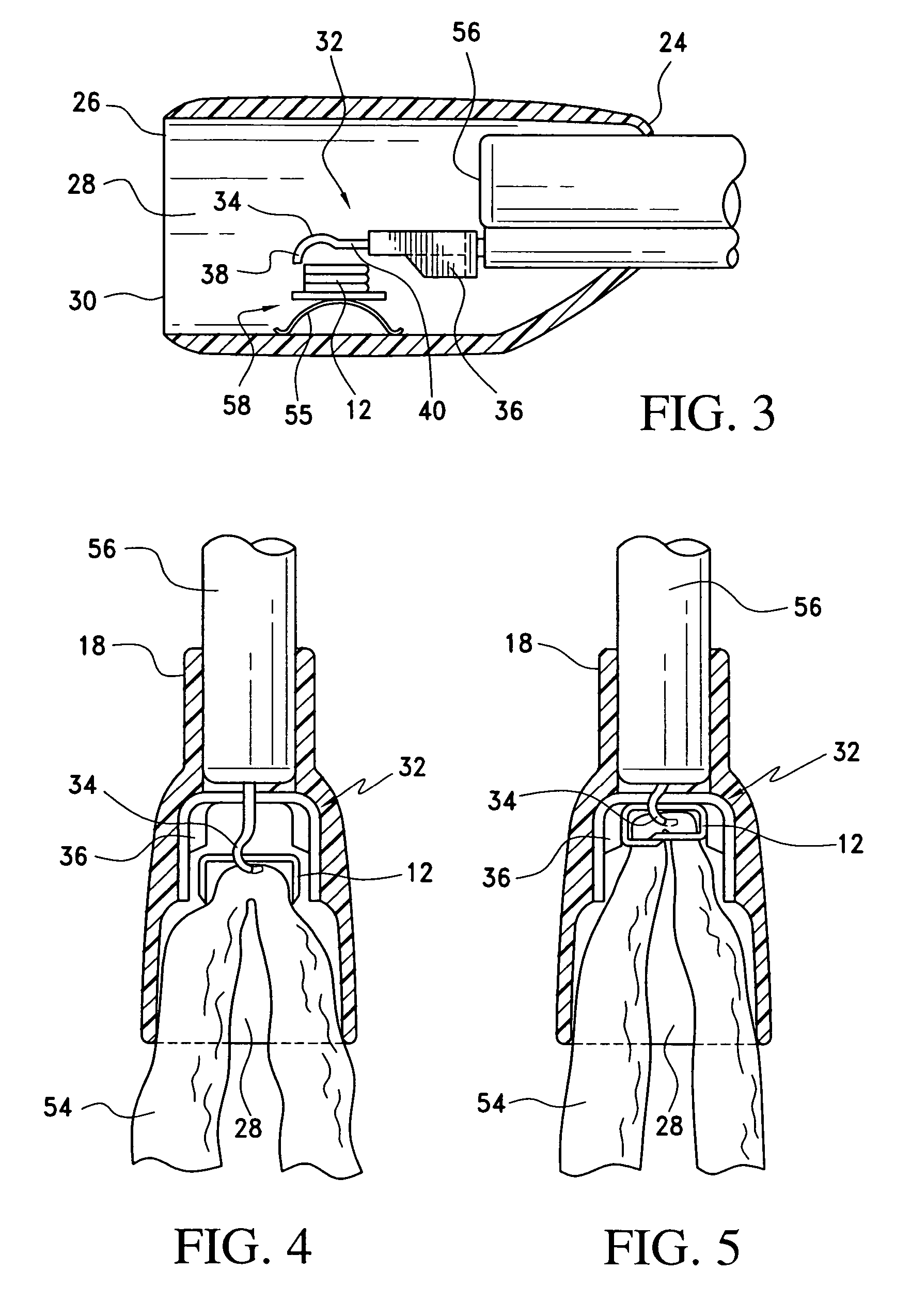 Method and apparatus for endoscopically performing gastric reduction surgery in a single pass