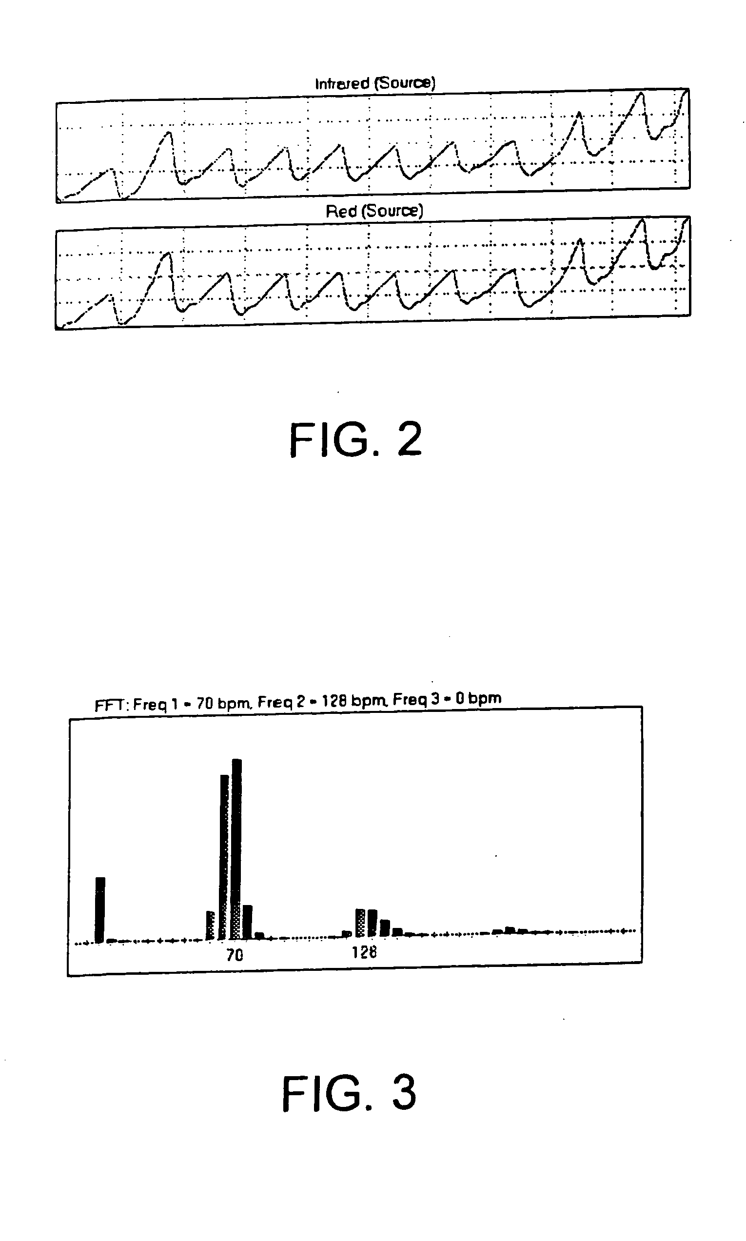 Method, apparatus and system for removing motion artifacts from measurements of bodily parameters