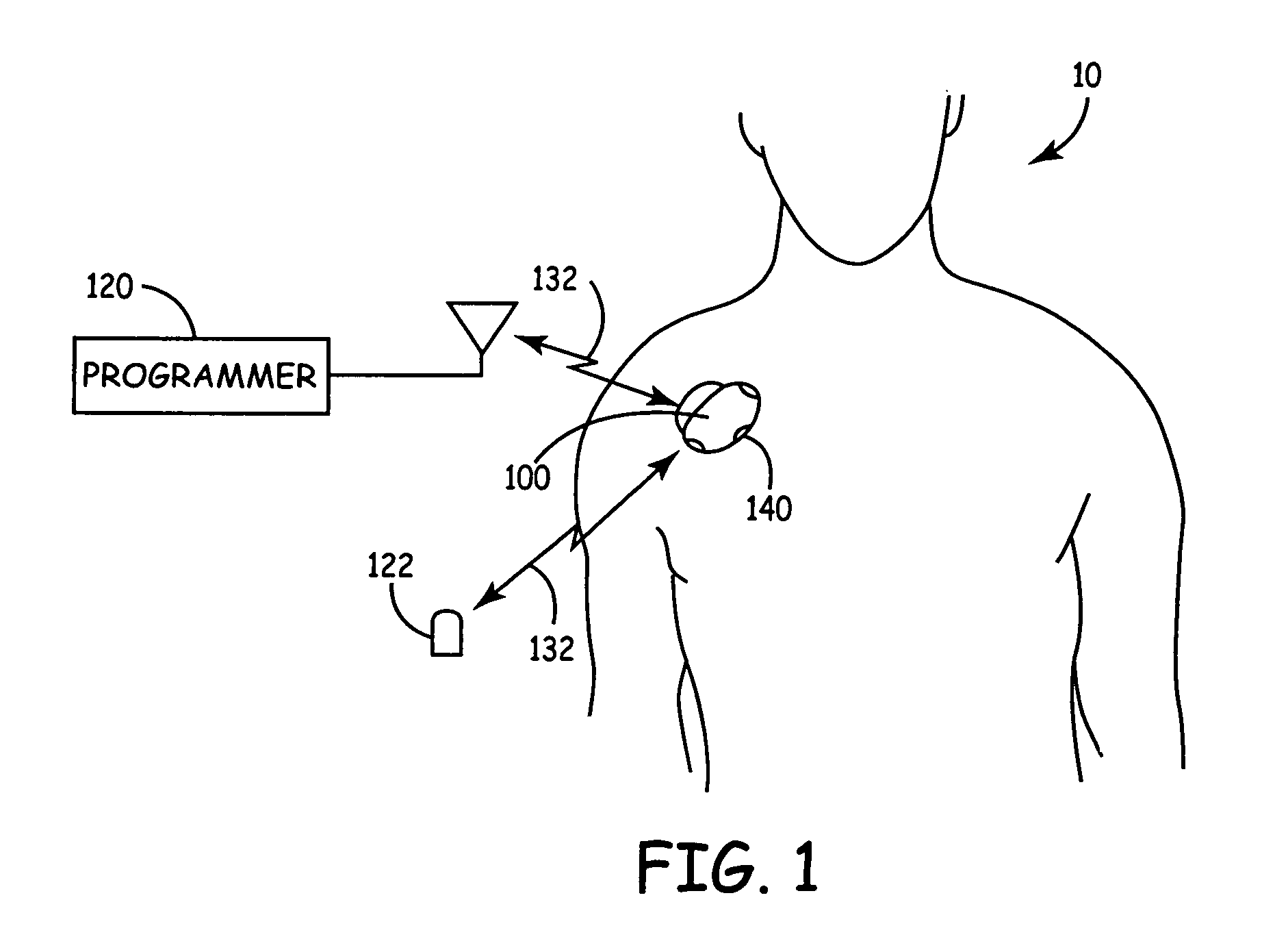Techniques for user-activated data retention in an implantable medical device