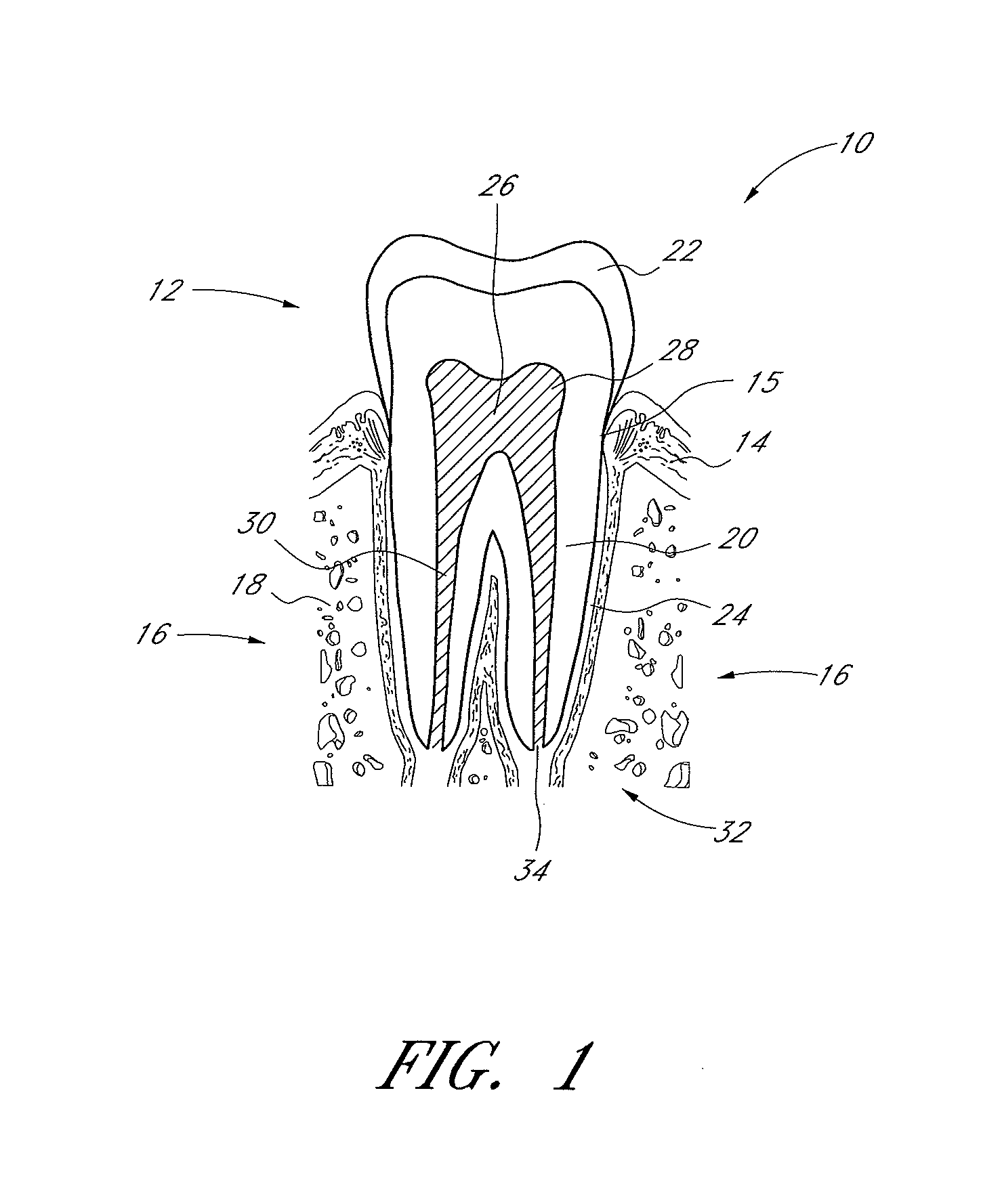 Apparatus and methods for root canal treatments