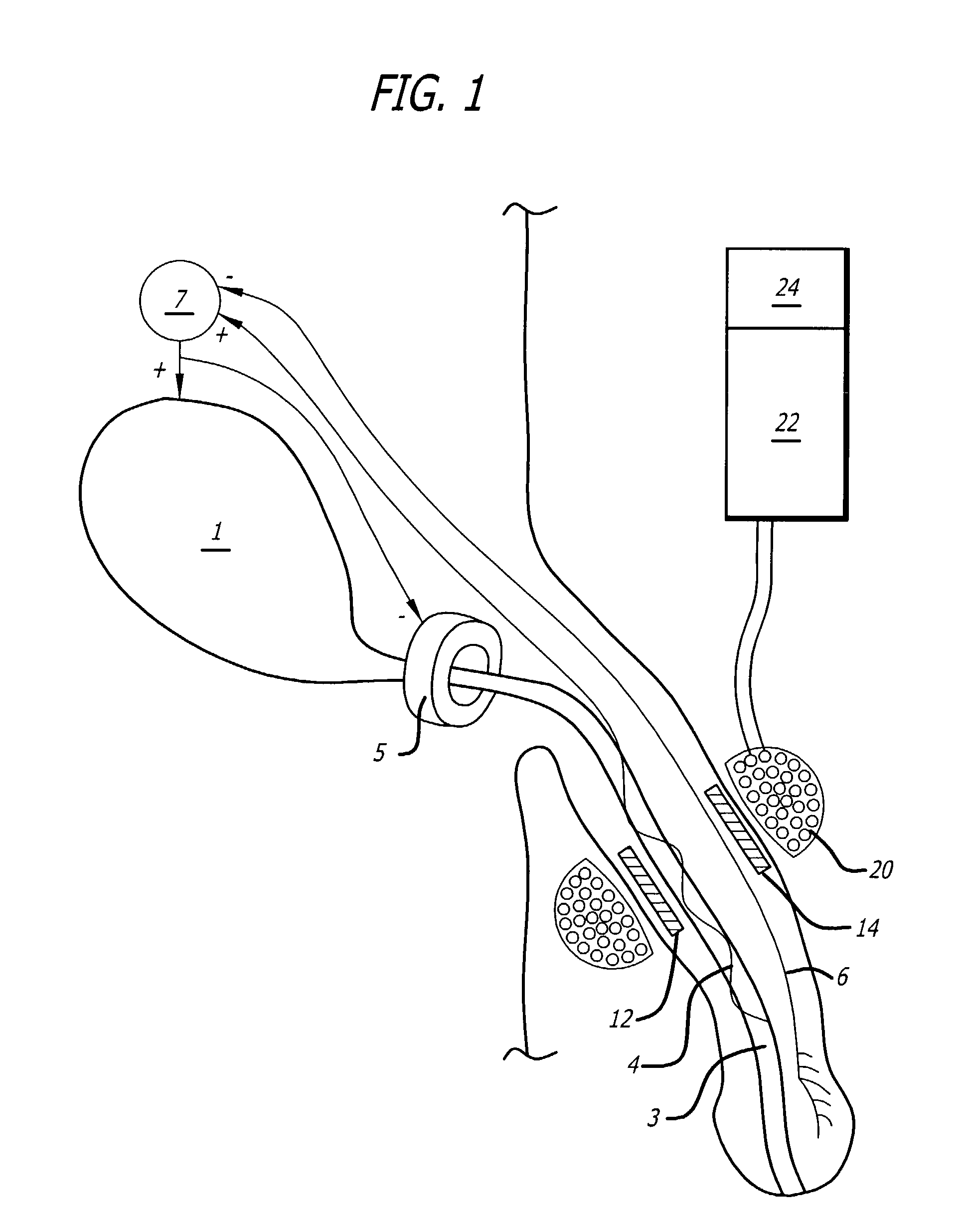 Method and apparatus for the treatment of urinary tract dysfunction