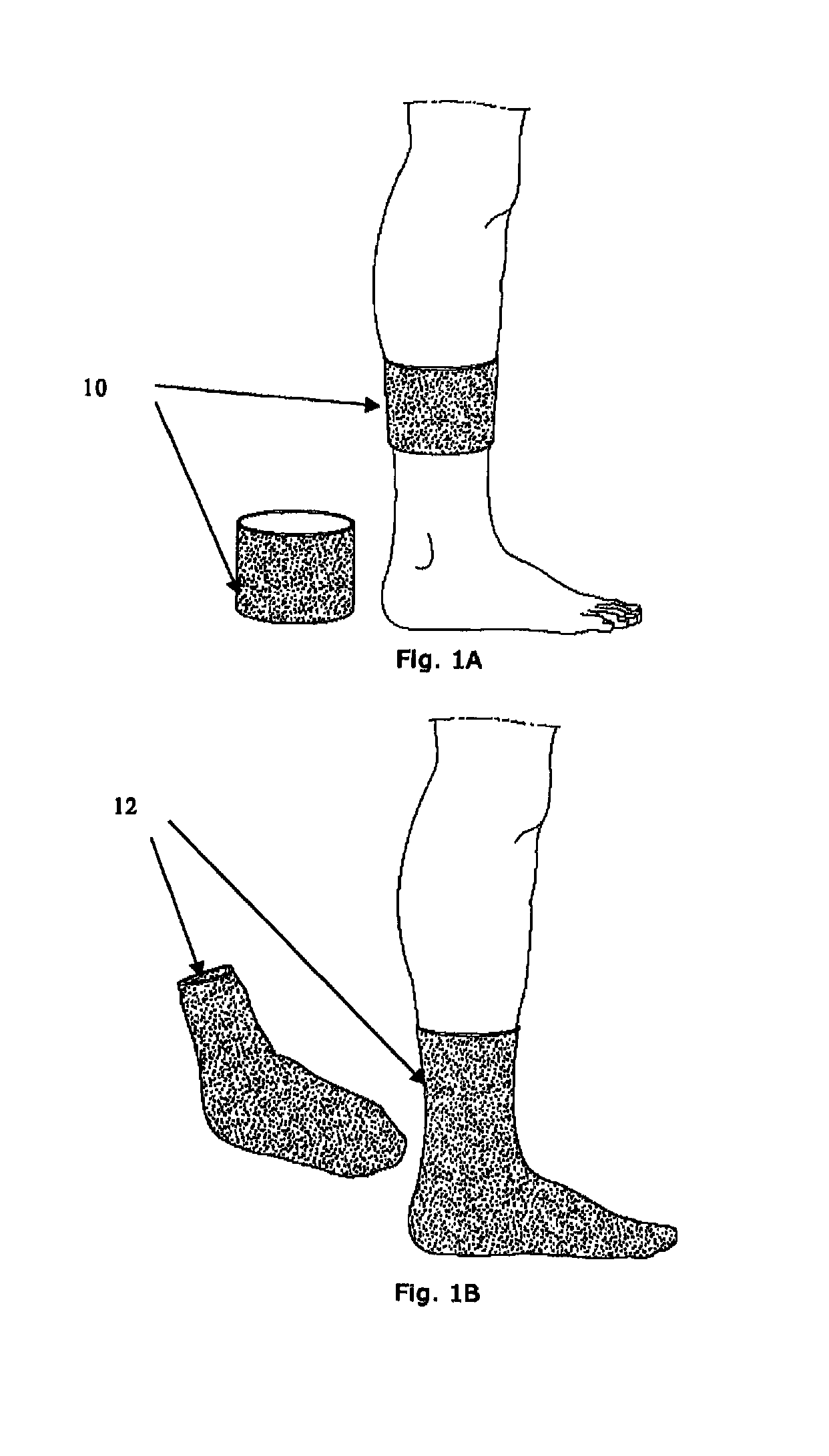 Device, method, and use for treatment of neuropathy involving nitric oxide