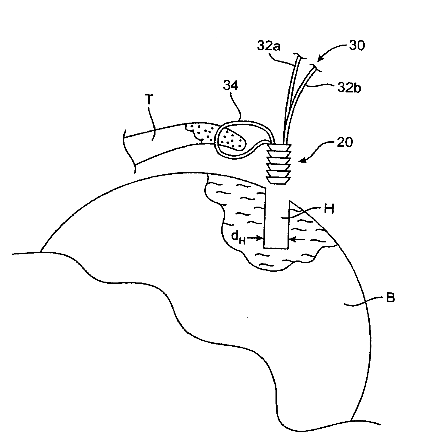 Tack anchor systems, bone anchor systems, and methods of use
