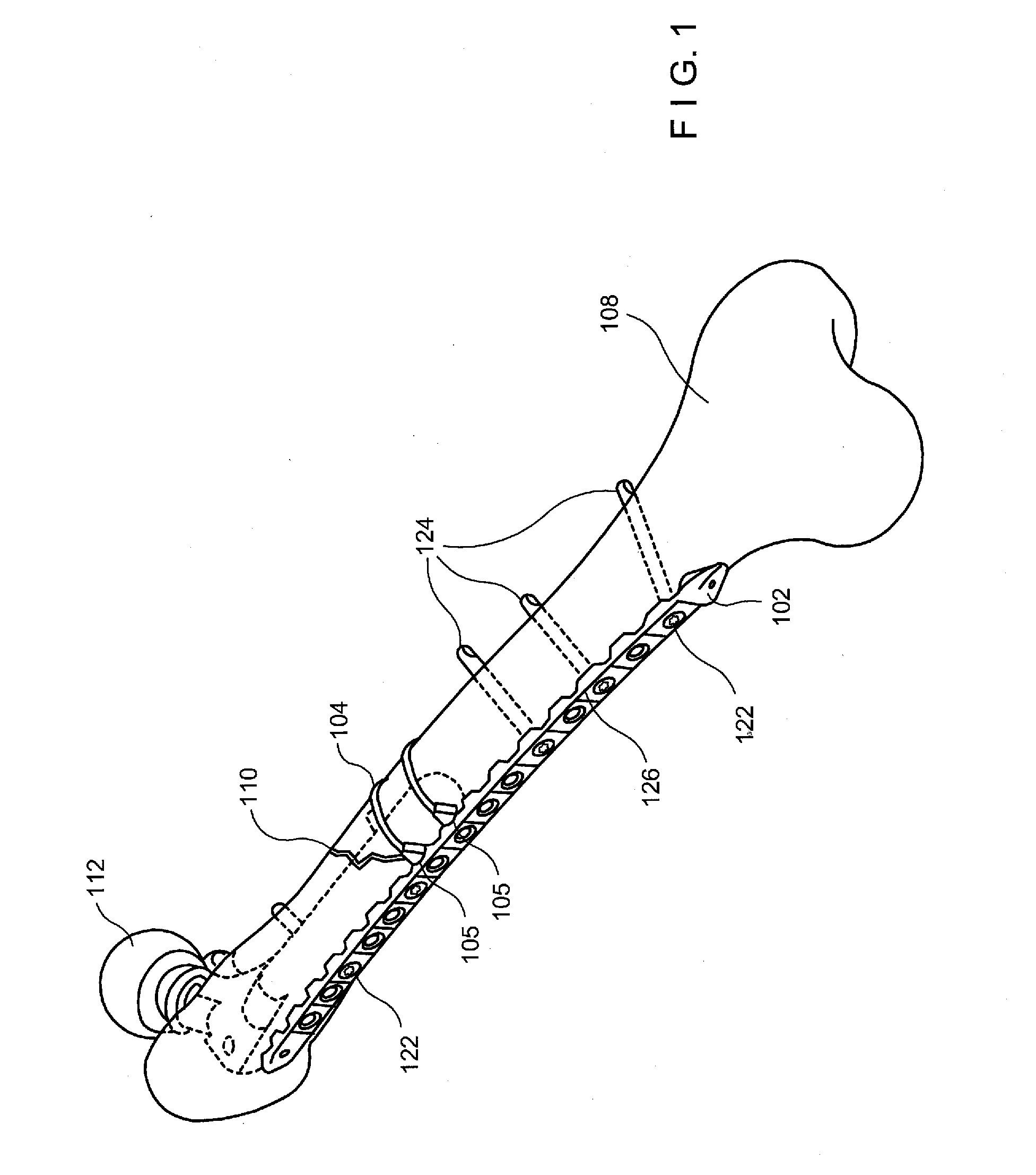 Minimally Invasive Implant and Crimping System