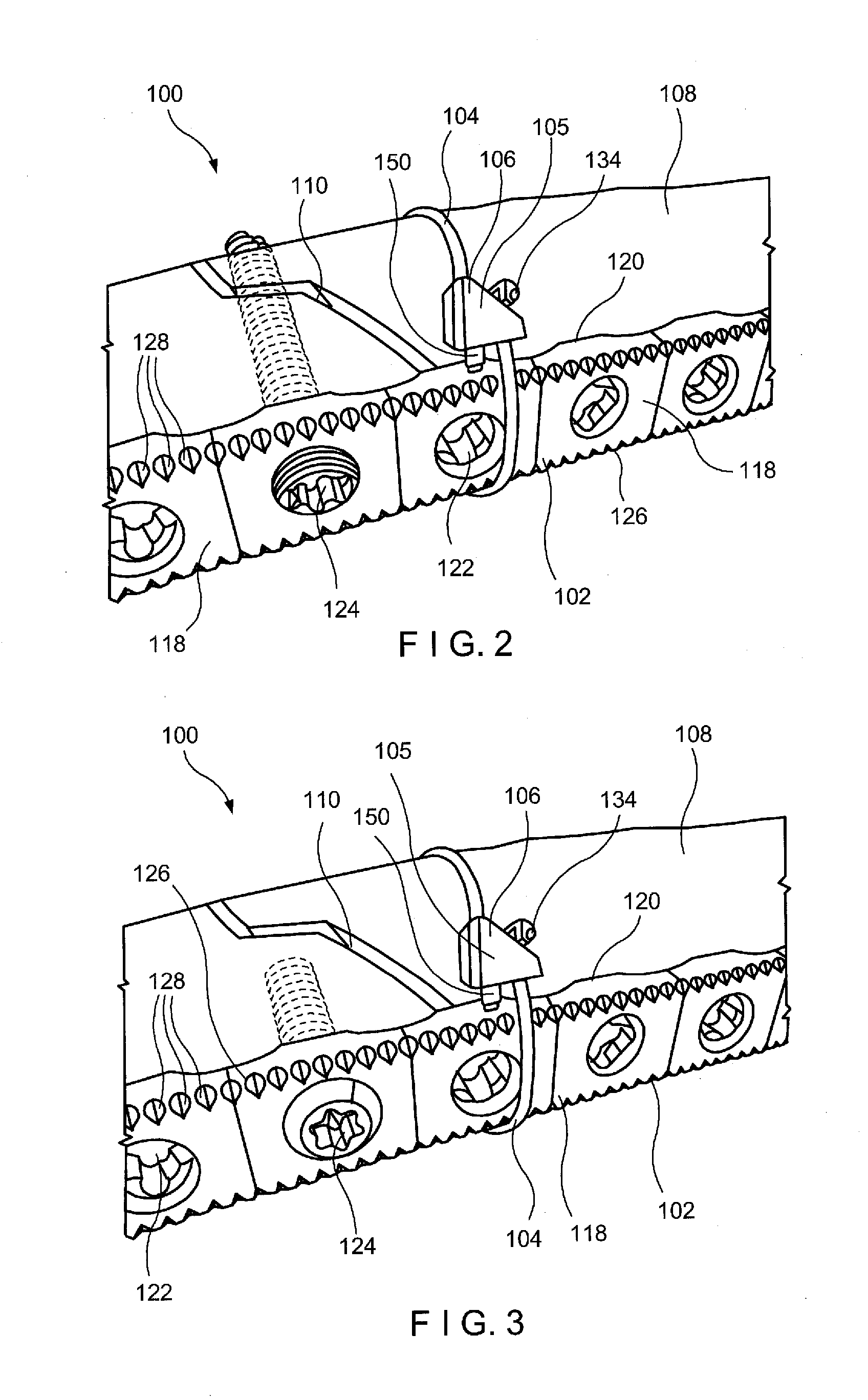 Minimally Invasive Implant and Crimping System