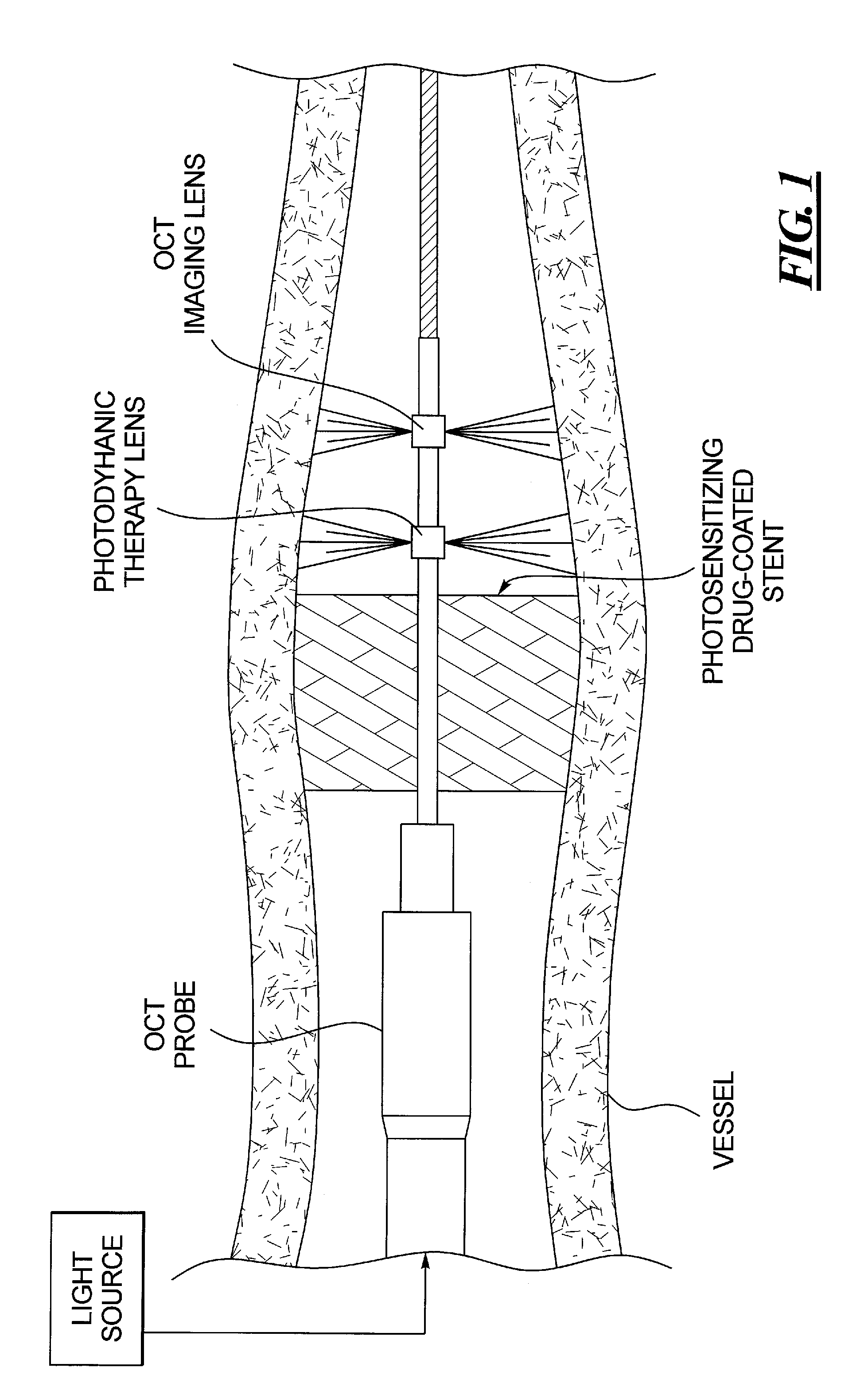 Combined oct catheter device and method for combined optical coherence tomography (OCT) diagnosis and photodynamic therapy (PDT)