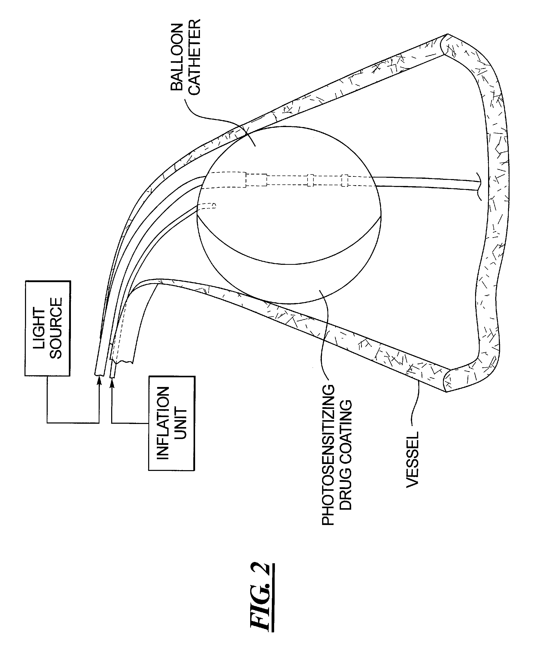 Combined oct catheter device and method for combined optical coherence tomography (OCT) diagnosis and photodynamic therapy (PDT)