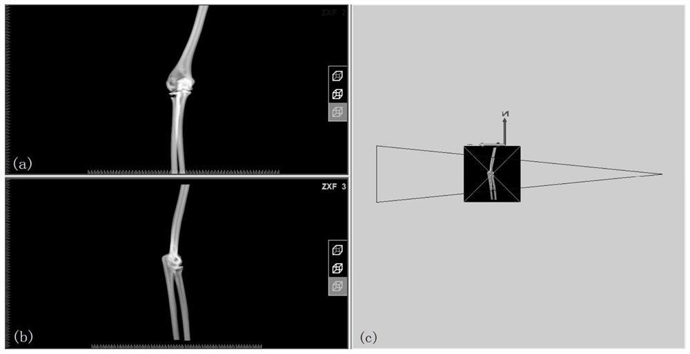 Mimics-based computer simulation double-wedge-shaped osteotomy method
