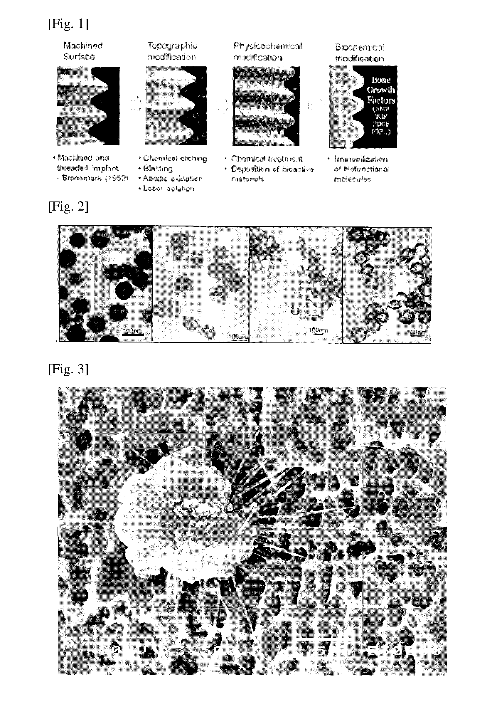 Surface-modified hybrid surface implant and method for  manufacturing the same