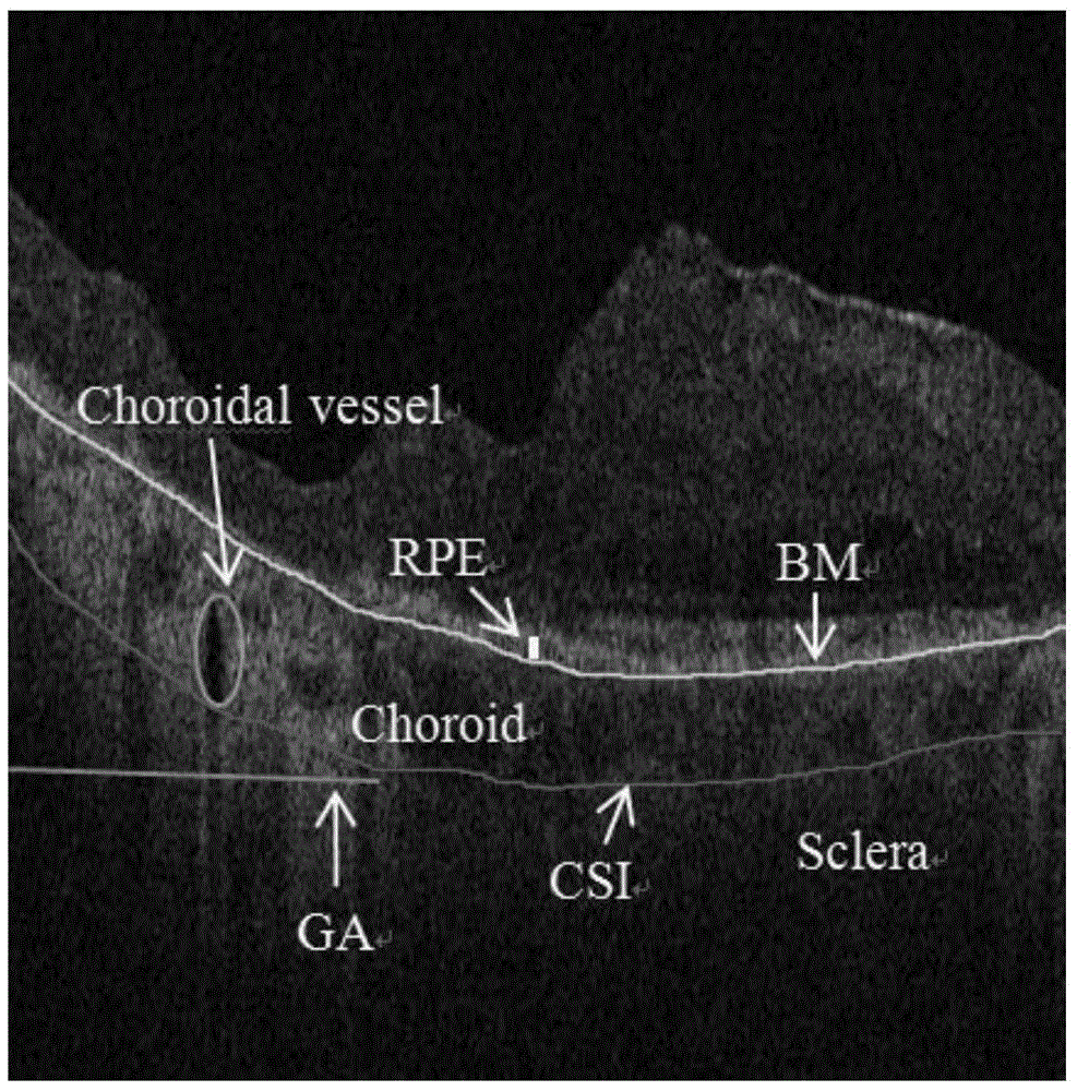 Map-like atrophy projection image generation method based on sd-oct retinal images