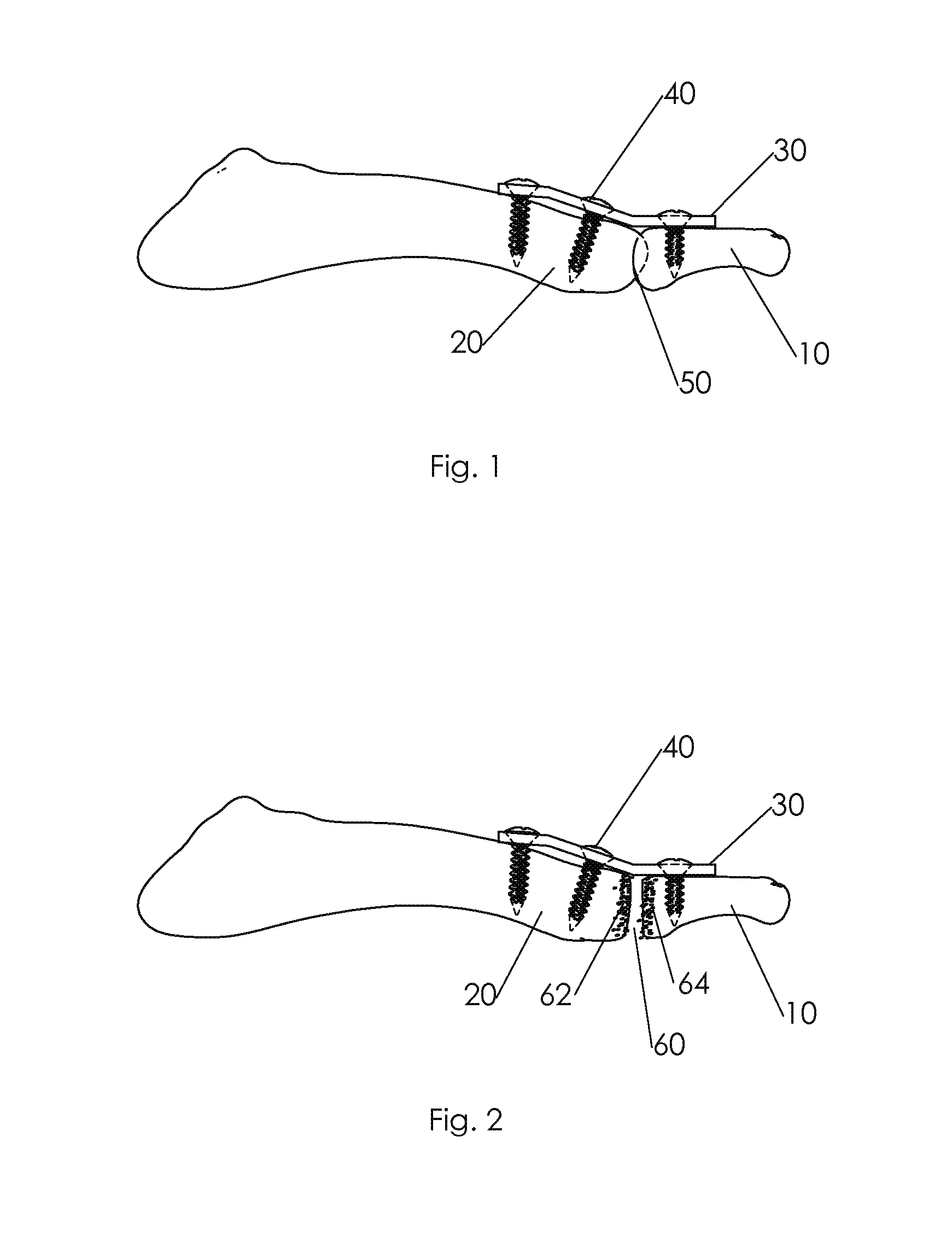 Shape changing bone implant and method of use for enhancing healing
