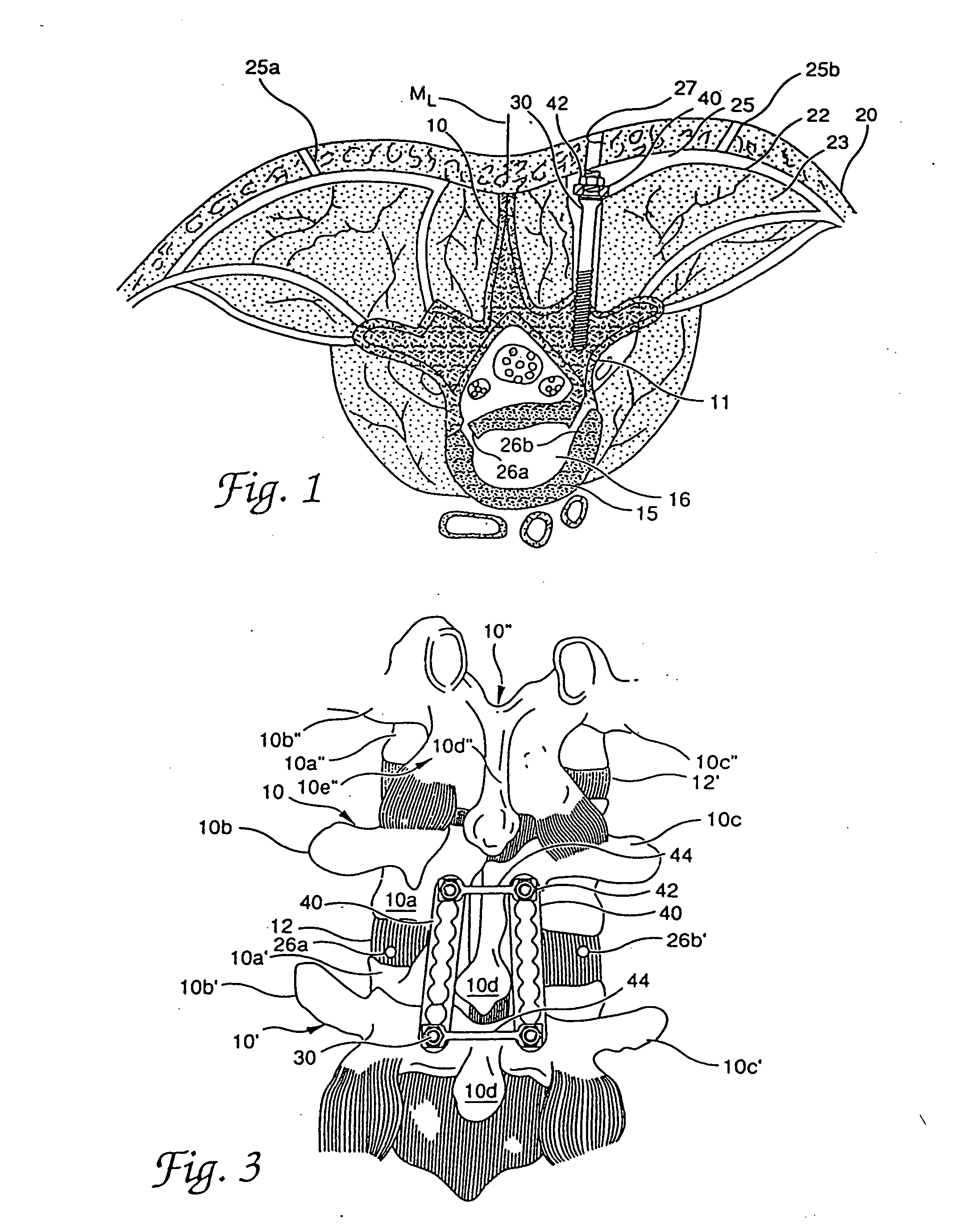 Systems and methods for fixation of adjacent vertebrae