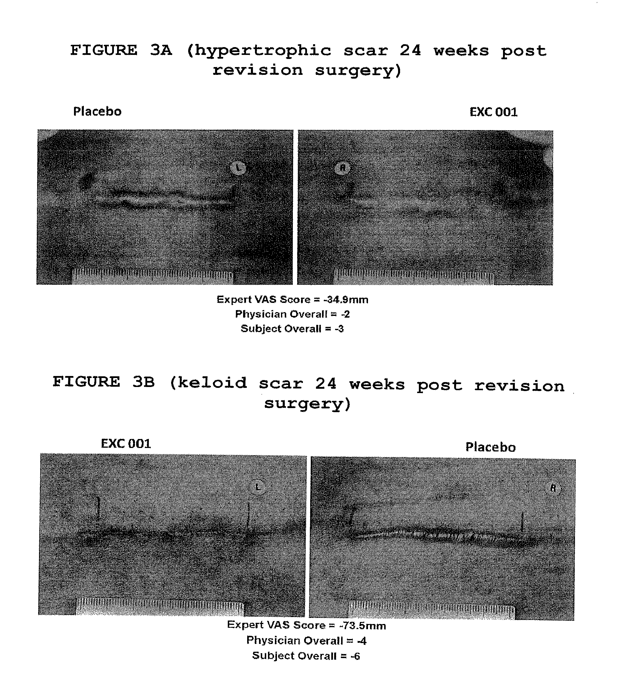 Method of treating keloids or hypertrophic scars using antisense compounds targeting connective tissue growth factor (CTGF)
