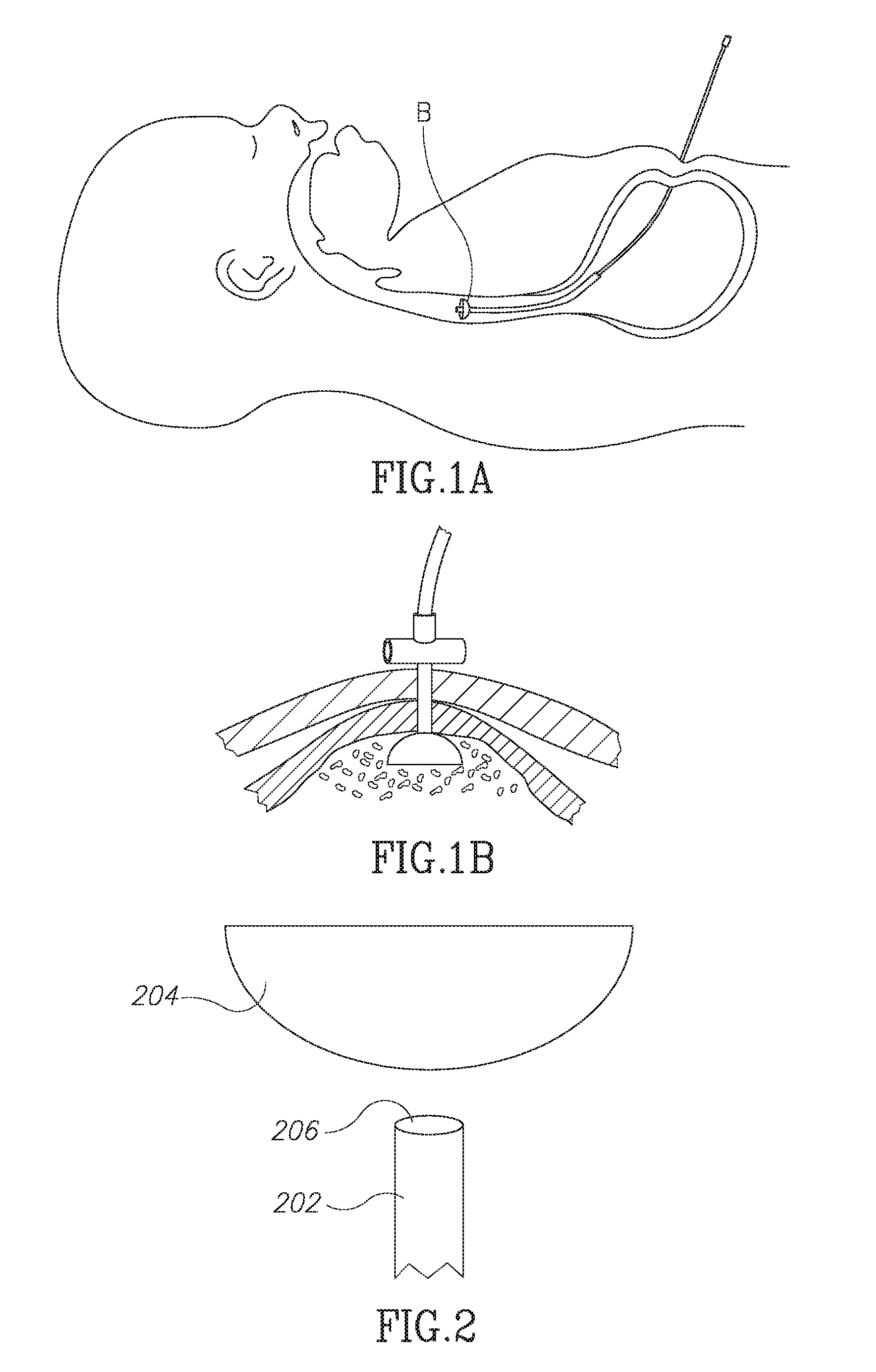 Devices and methods for percutaneous endoscopic gastrostomy and other ostomy procedures