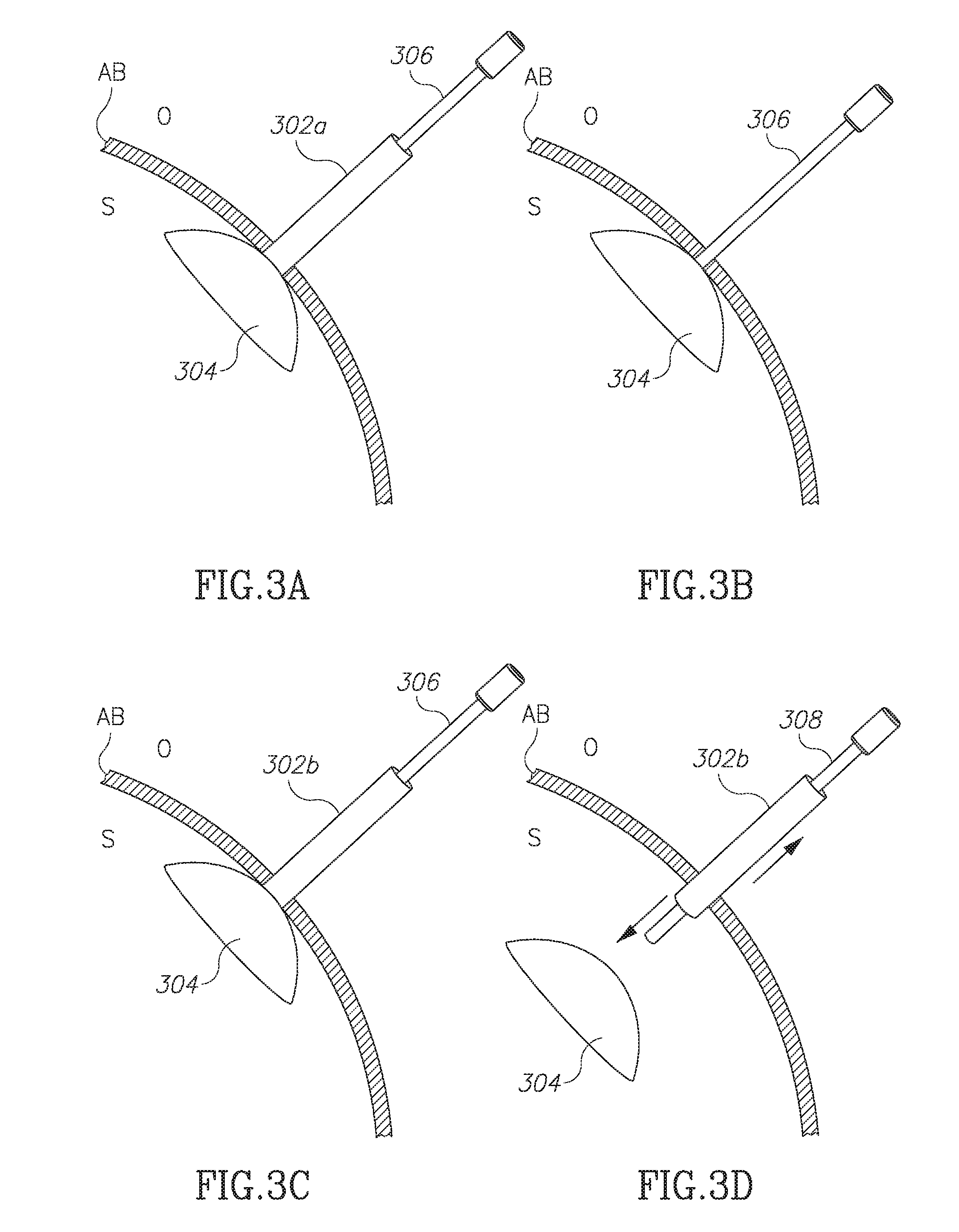 Devices and methods for percutaneous endoscopic gastrostomy and other ostomy procedures