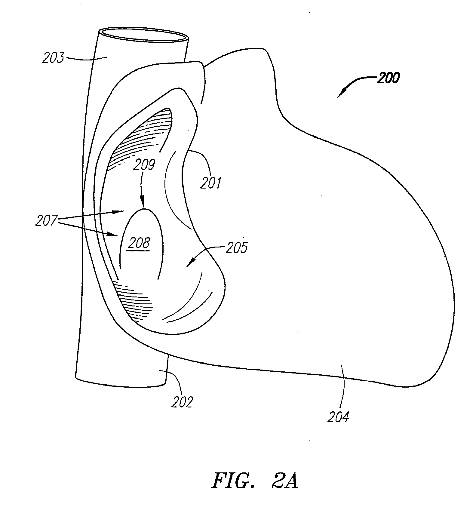 Systems and Methods for Treating Septal Defects