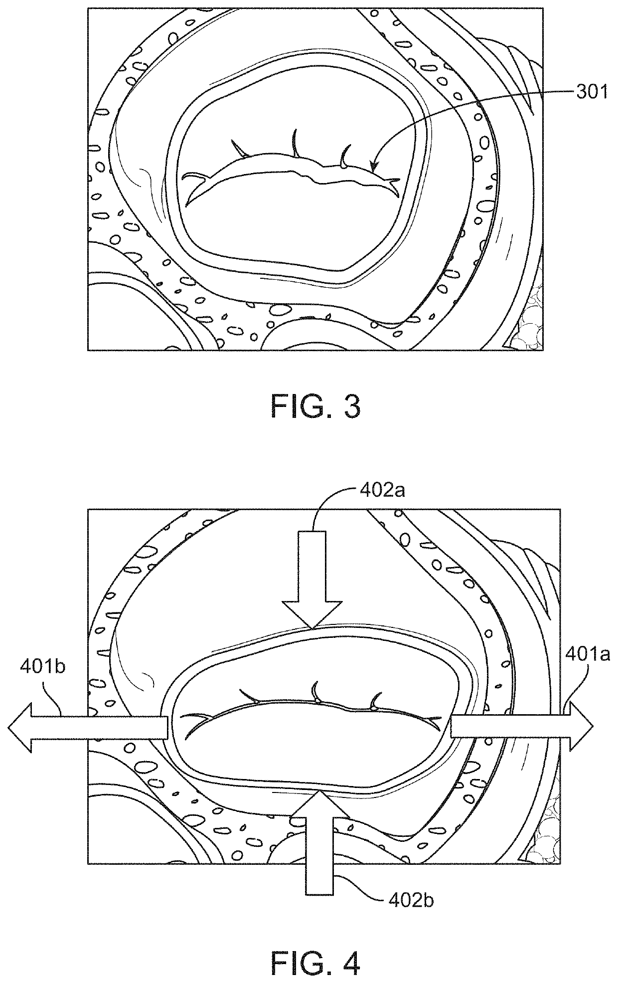 Methods and devices for heart valve repair