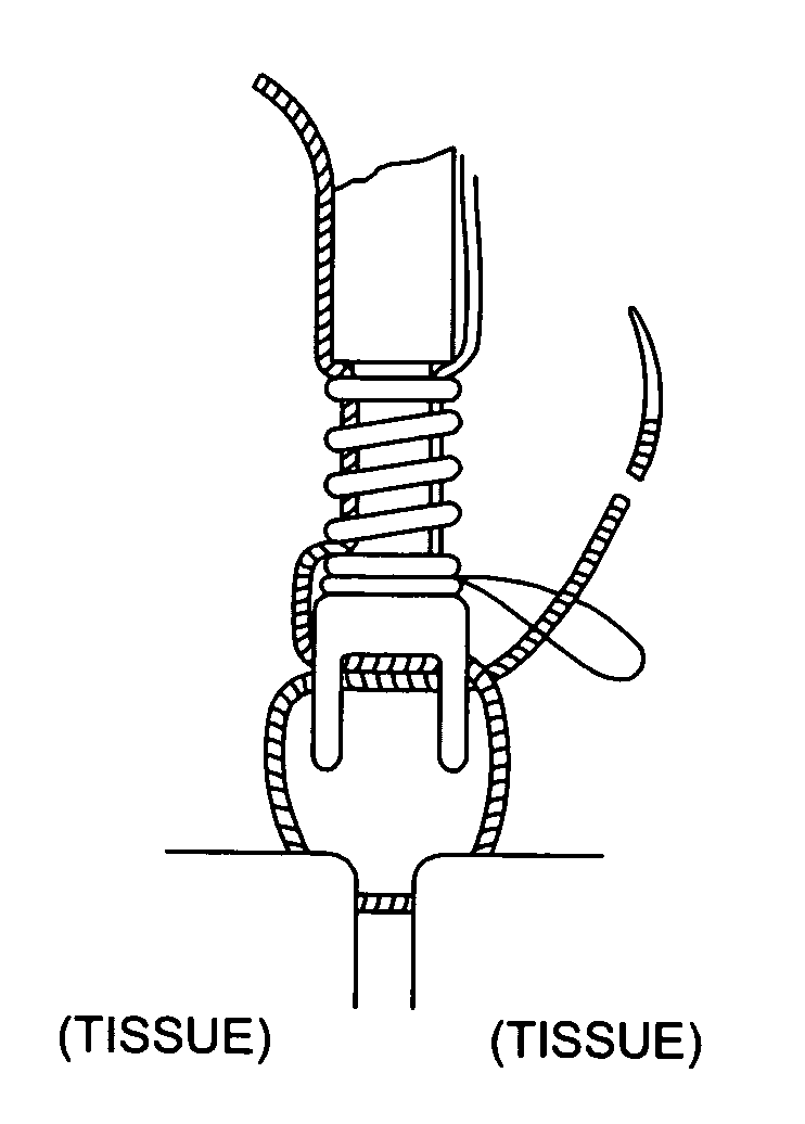 Weldable flexible longitudinal fixation components and instruments associated therewith