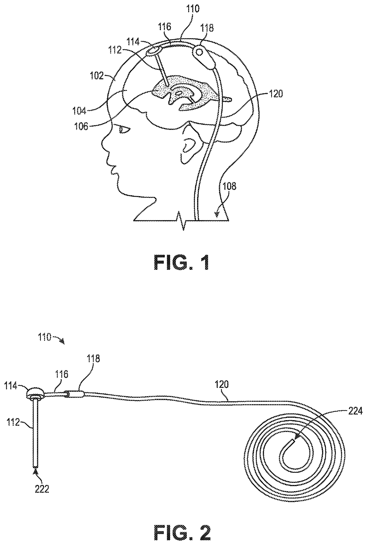 Implantable Intracranial Pressure Sensor