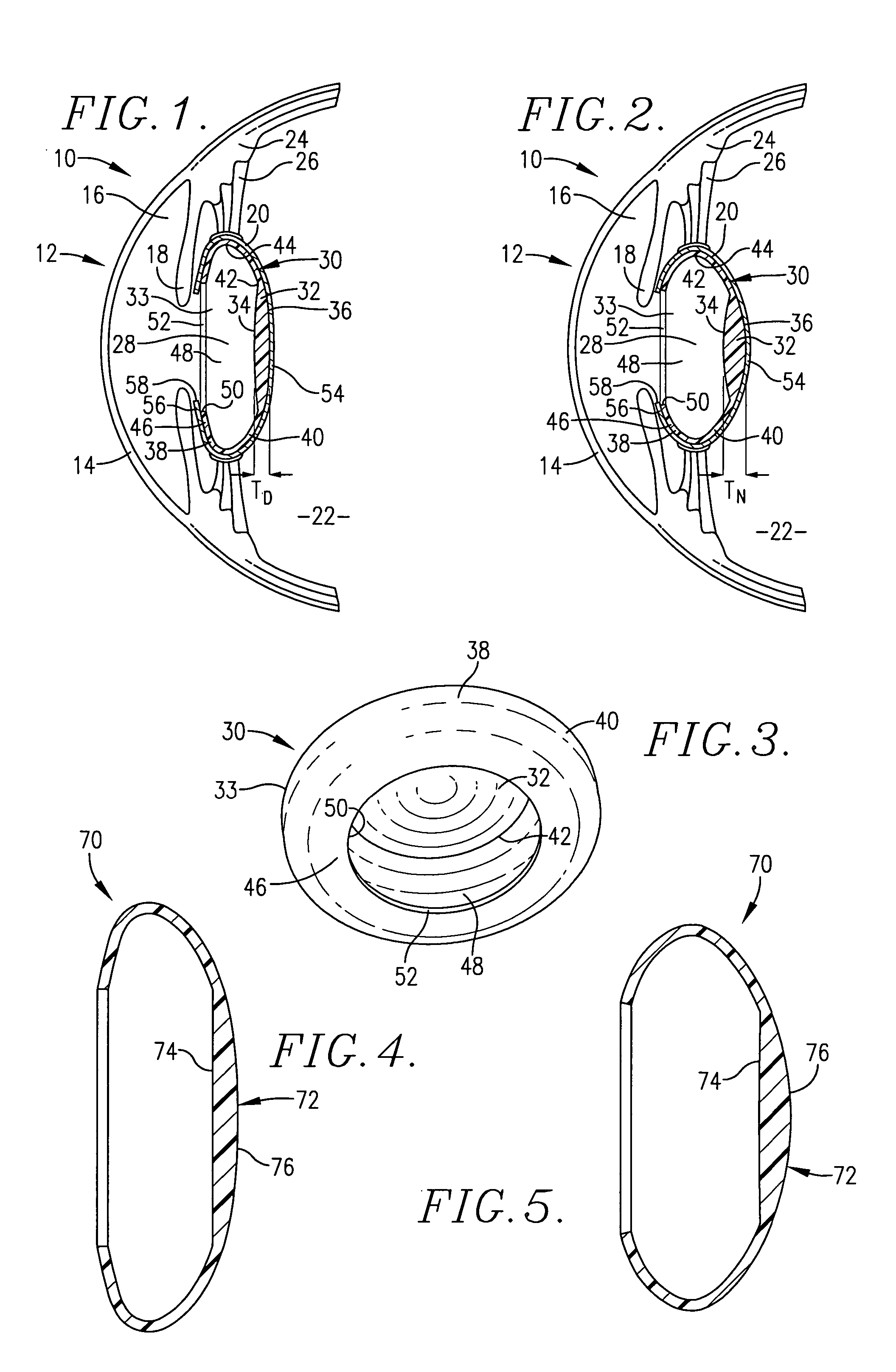 Intraocular lens implant having posterior bendable optic