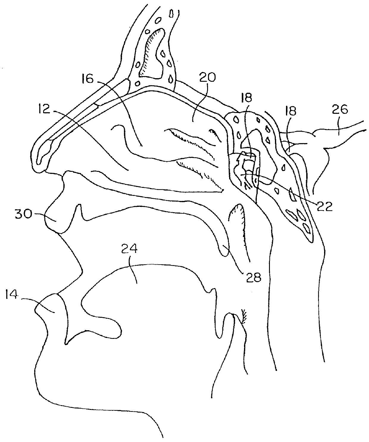 Materials and methods for treating neuropathies and related disorders including those involving a keystone nerve