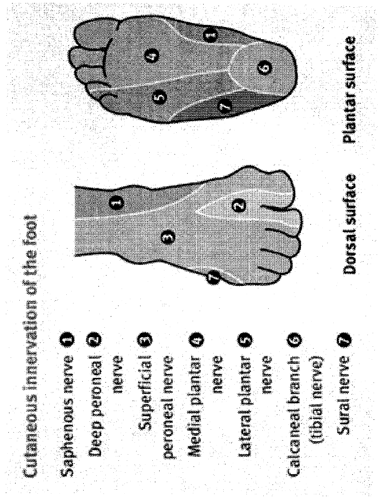 Materials and methods for treating neuropathies and related disorders including those involving a keystone nerve