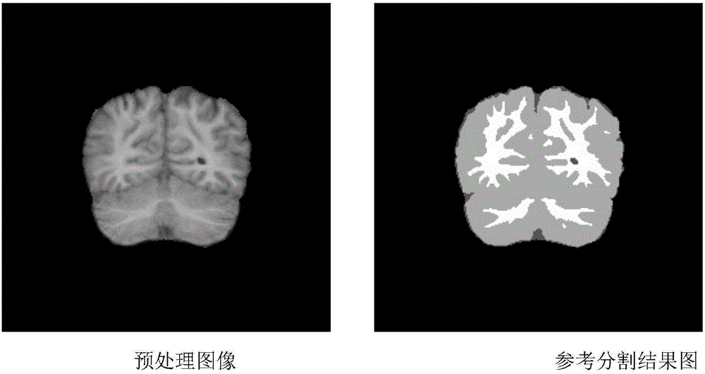 Truncated Dirichlet process infinite Student'st' hybrid model-based brain nuclear magnetic resonance image segmentation method