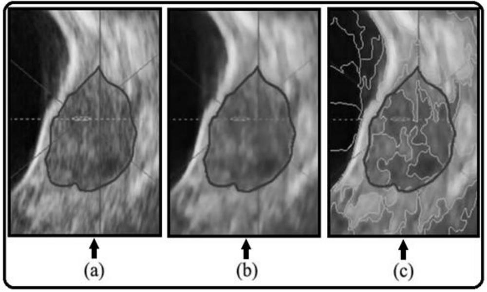 Efficient and accurate division method for ultrasonically positioning fibromyoma image