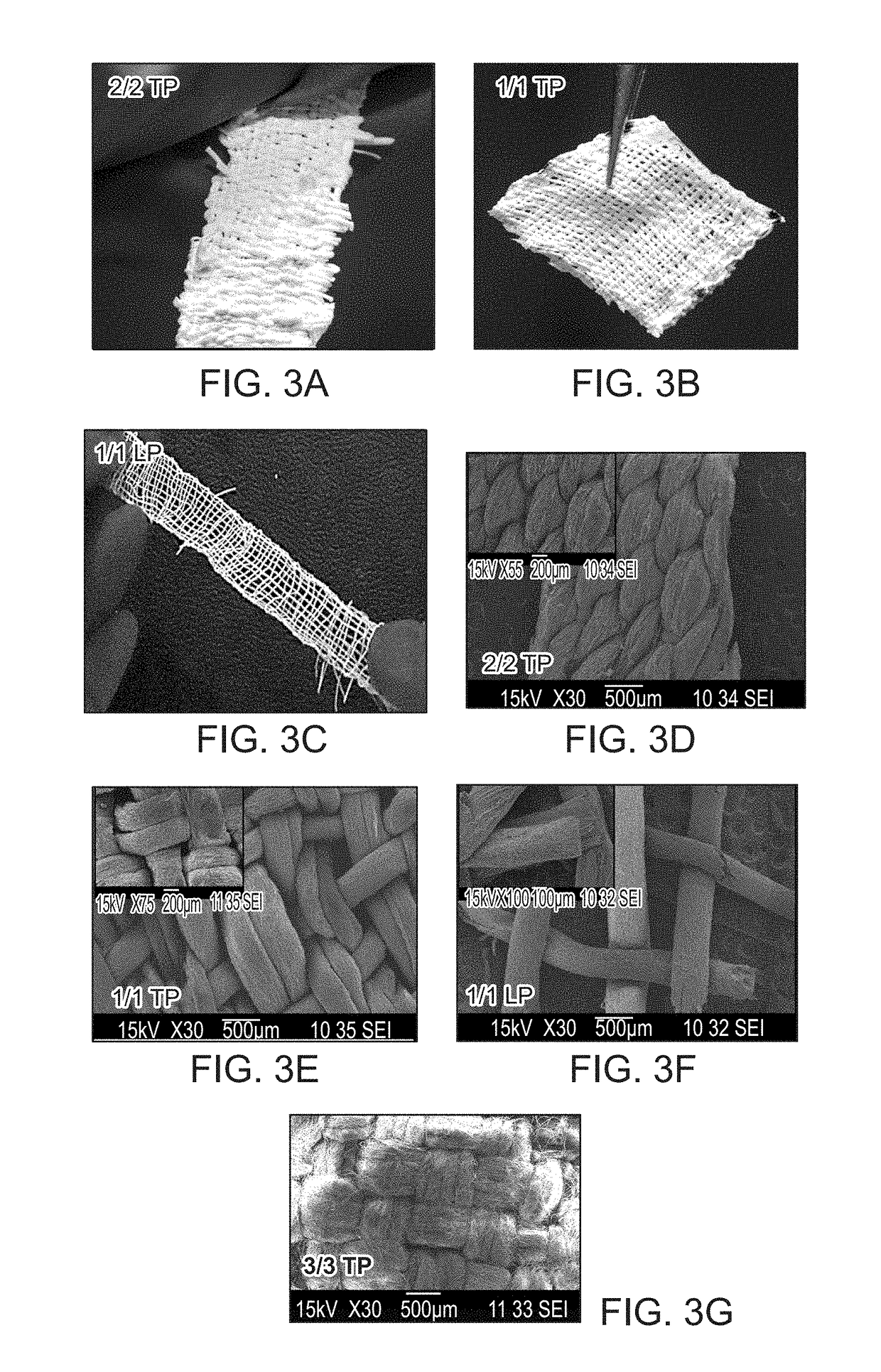 Suturable woven implants from electrospun yarns for sustained drug release in body cavities