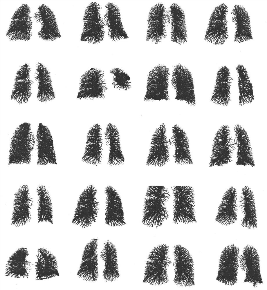 Pulmonary Vascular Tree Segmentation Method Combining Tubular Structure Enhancement and Energy Function