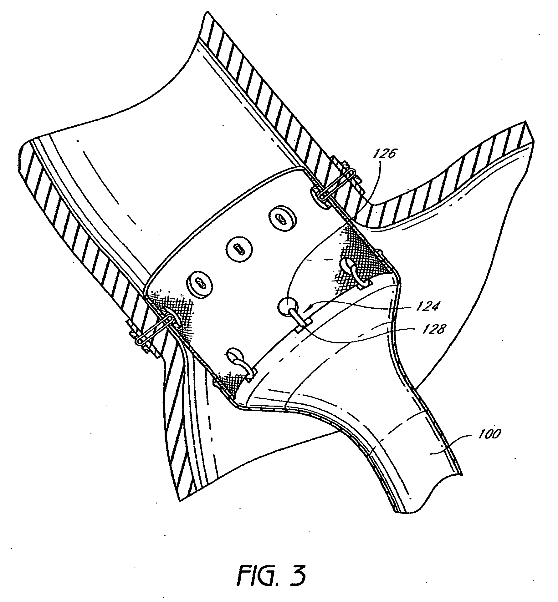 Cuff and sleeve system for gastrointestinal bypass